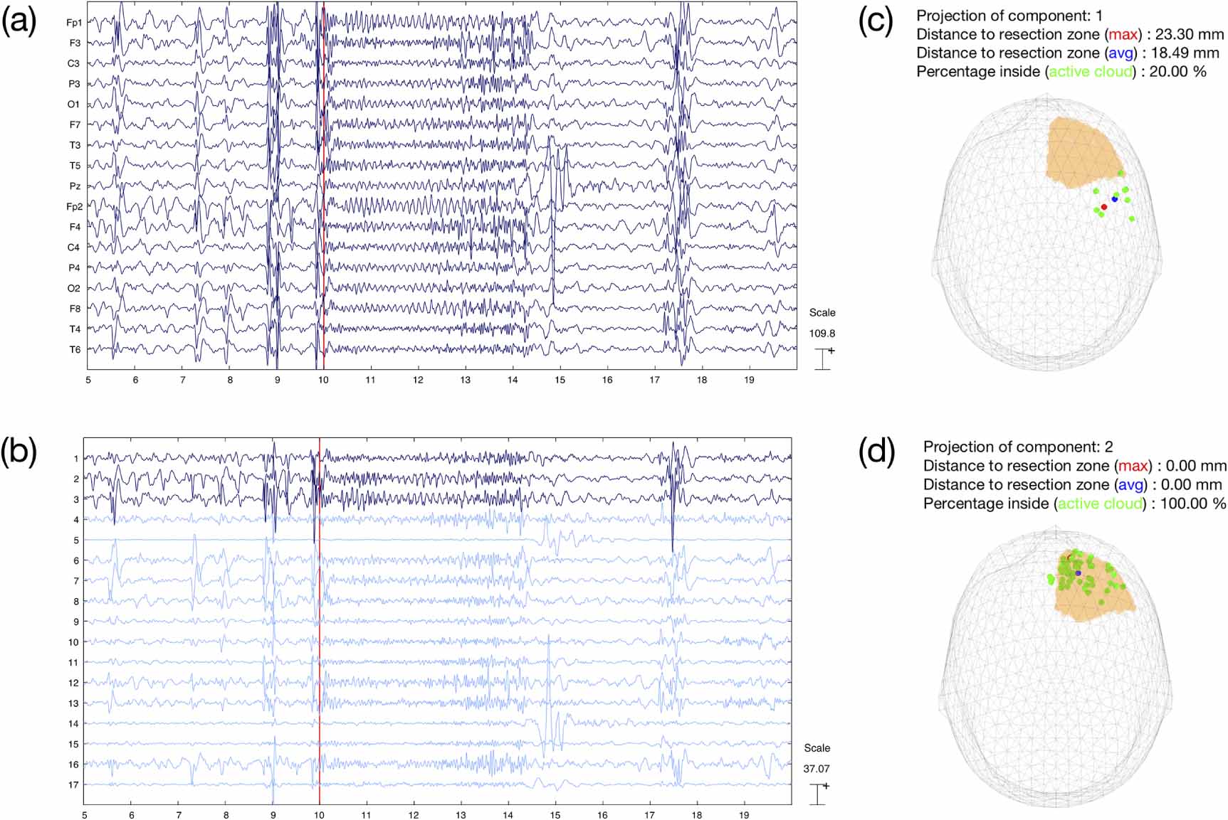 Estimation of seizure onset zone from ictal scalp EEG using independent ...