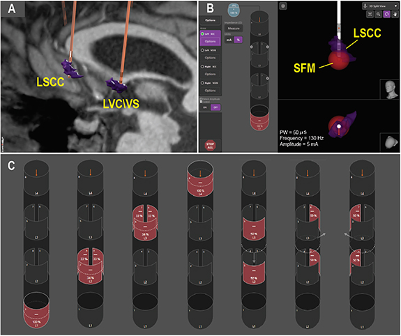 Automated optimization of deep brain stimulation parameters for ...