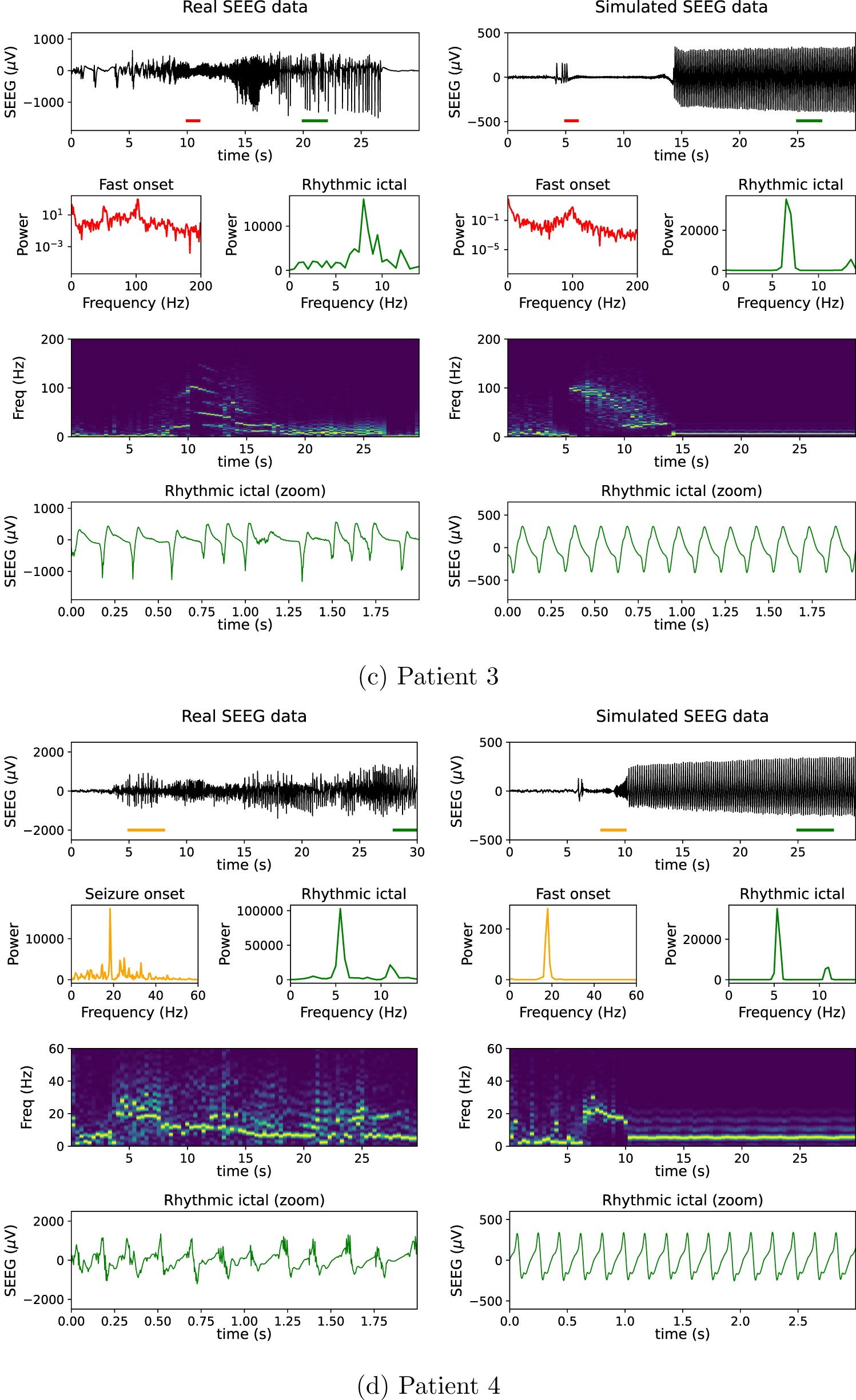 A personalizable autonomous neural mass model of epileptic seizures ...