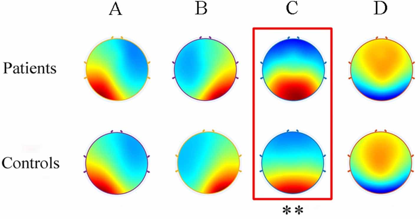 EEG microstate in first-episode drug-naive adolescents with depression ...