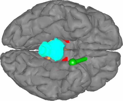 In silico study of the effects of cerebral circulation on source ...