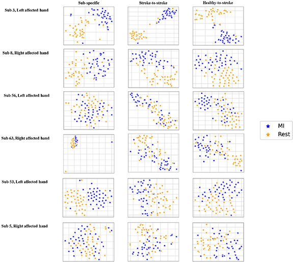 Transferring a deep learning model from healthy subjects to stroke ...