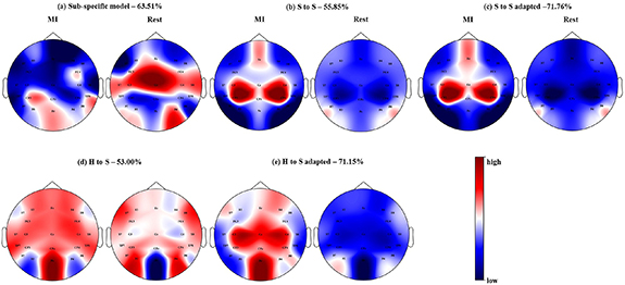 Transferring a deep learning model from healthy subjects to stroke ...