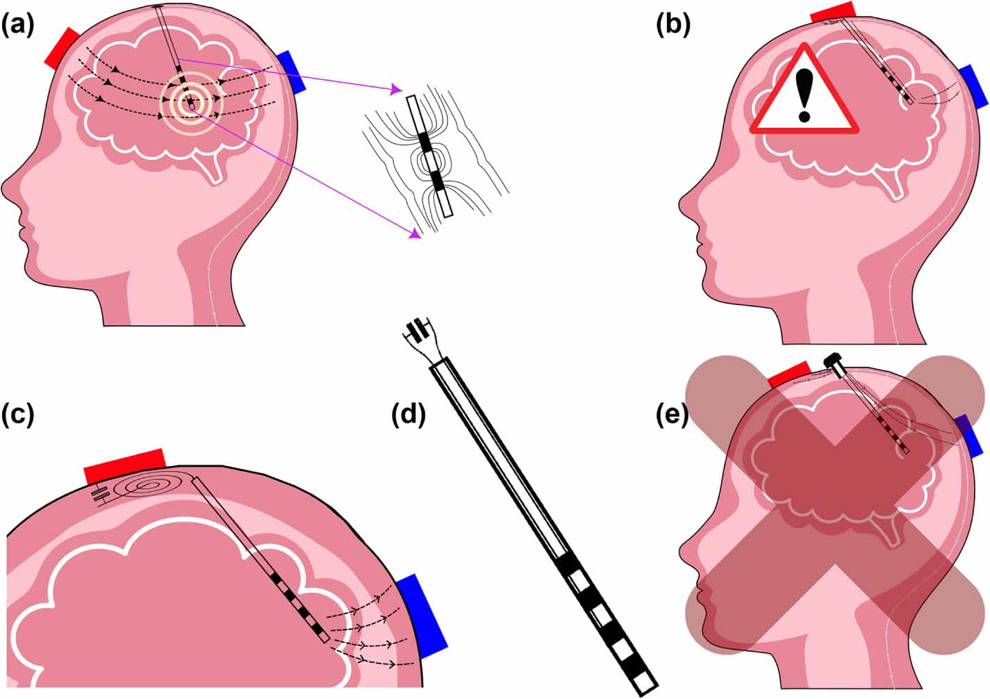 Safety of non-invasive brain stimulation in patients with implants: a ...