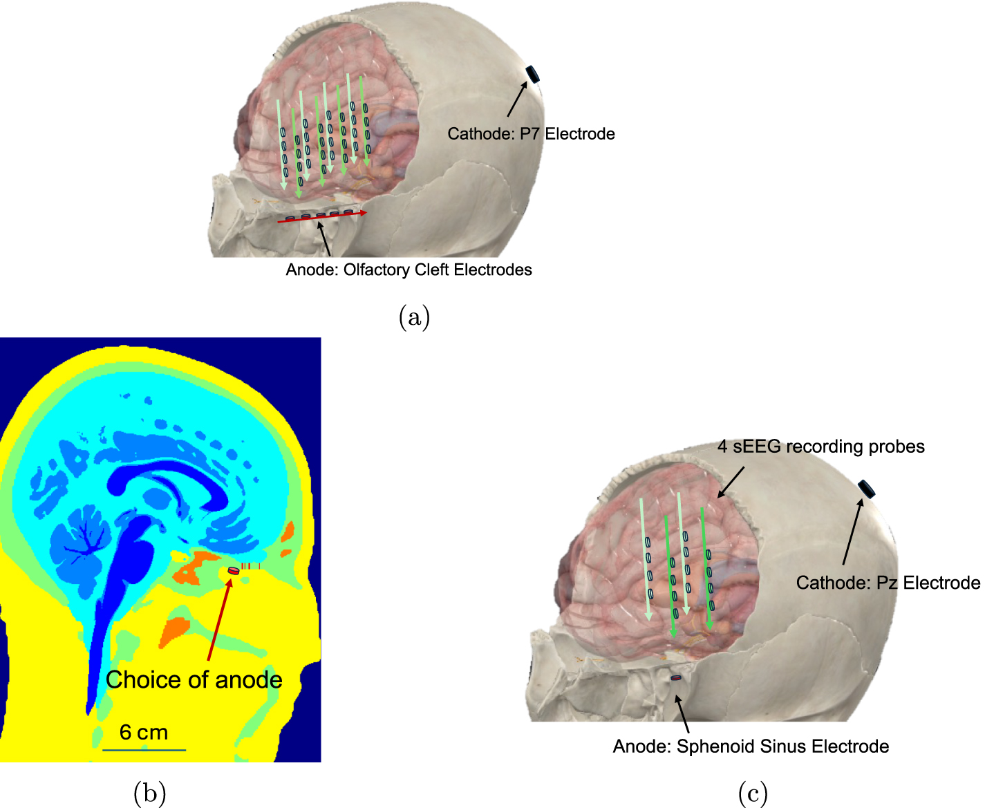 DeepFocus: a transnasal approach for optimized deep brain stimulation ...