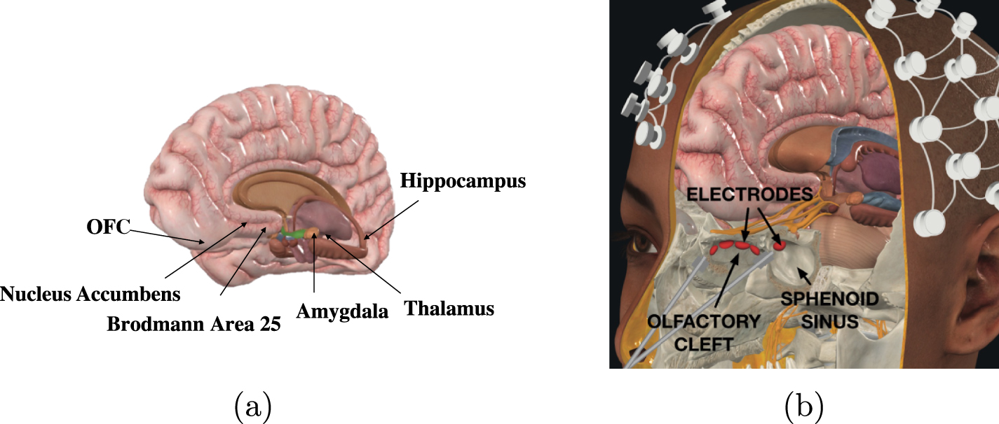 DeepFocus: a transnasal approach for optimized deep brain stimulation ...