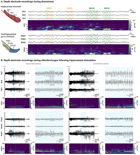 High-accuracy electrode implantation in deep brain structures using ...