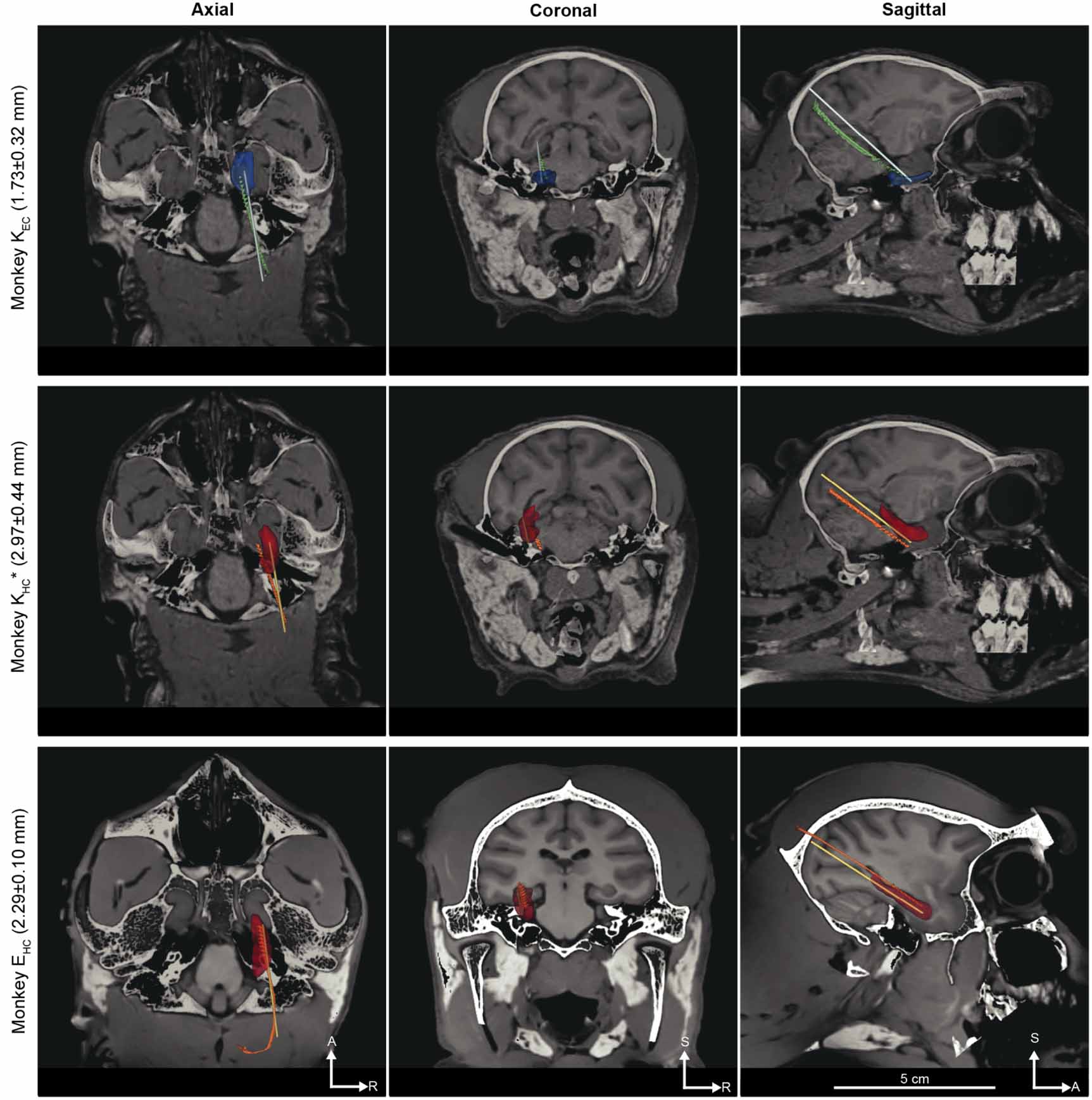 High-accuracy electrode implantation in deep brain structures using ...