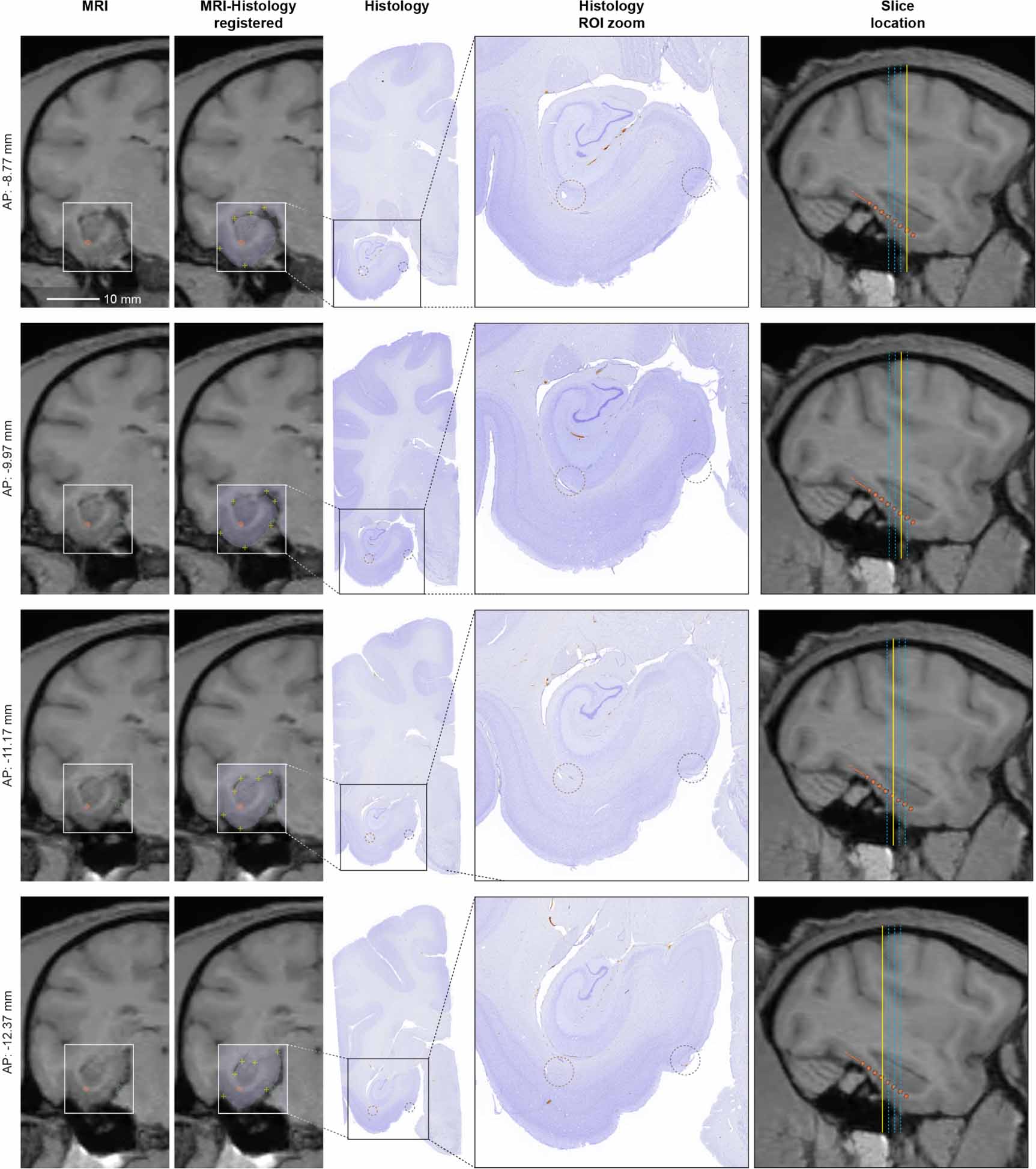 High-accuracy electrode implantation in deep brain structures using ...