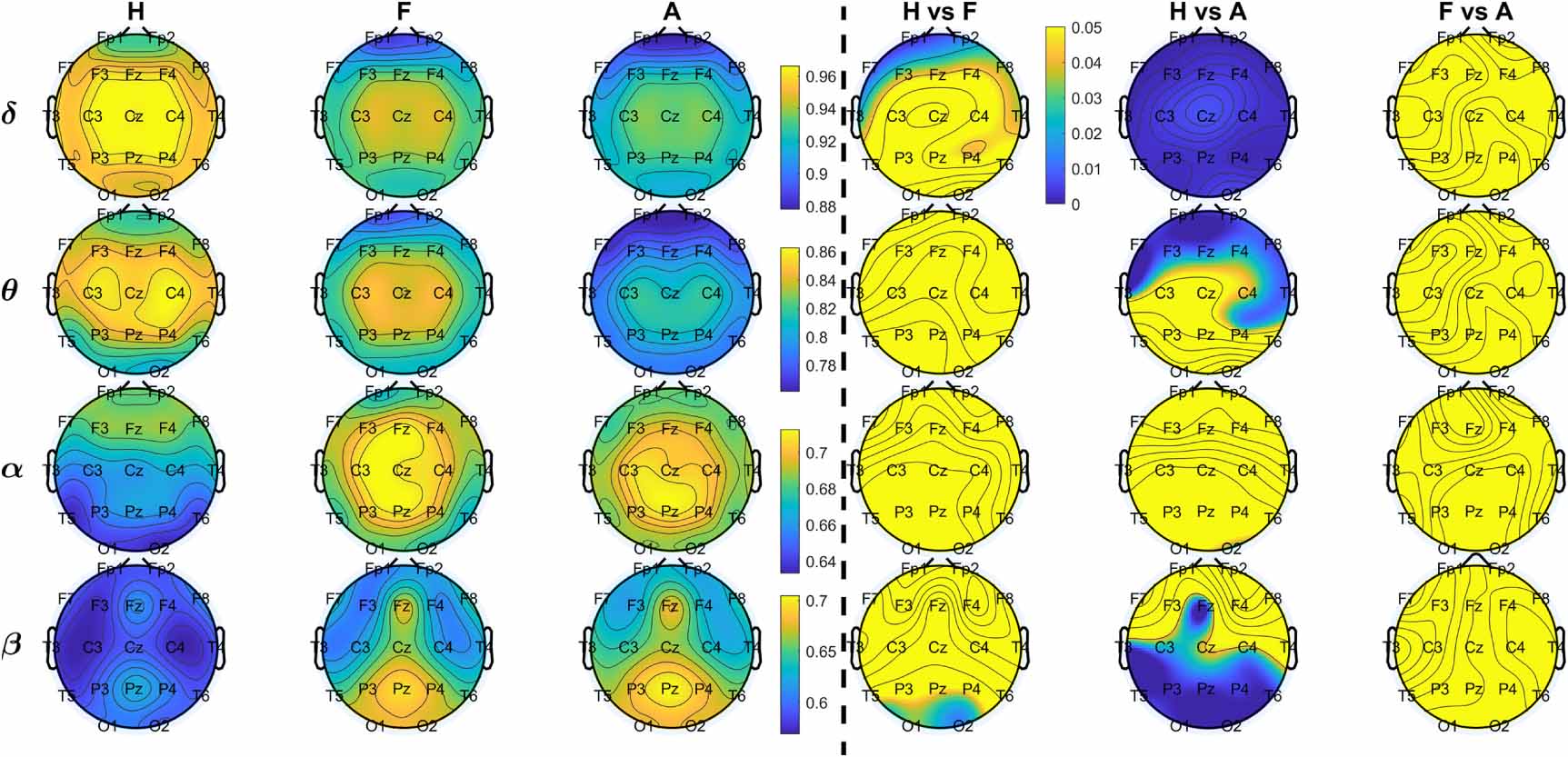 Spectral brain connectivity in dementia: coherence, imaginary coherence ...