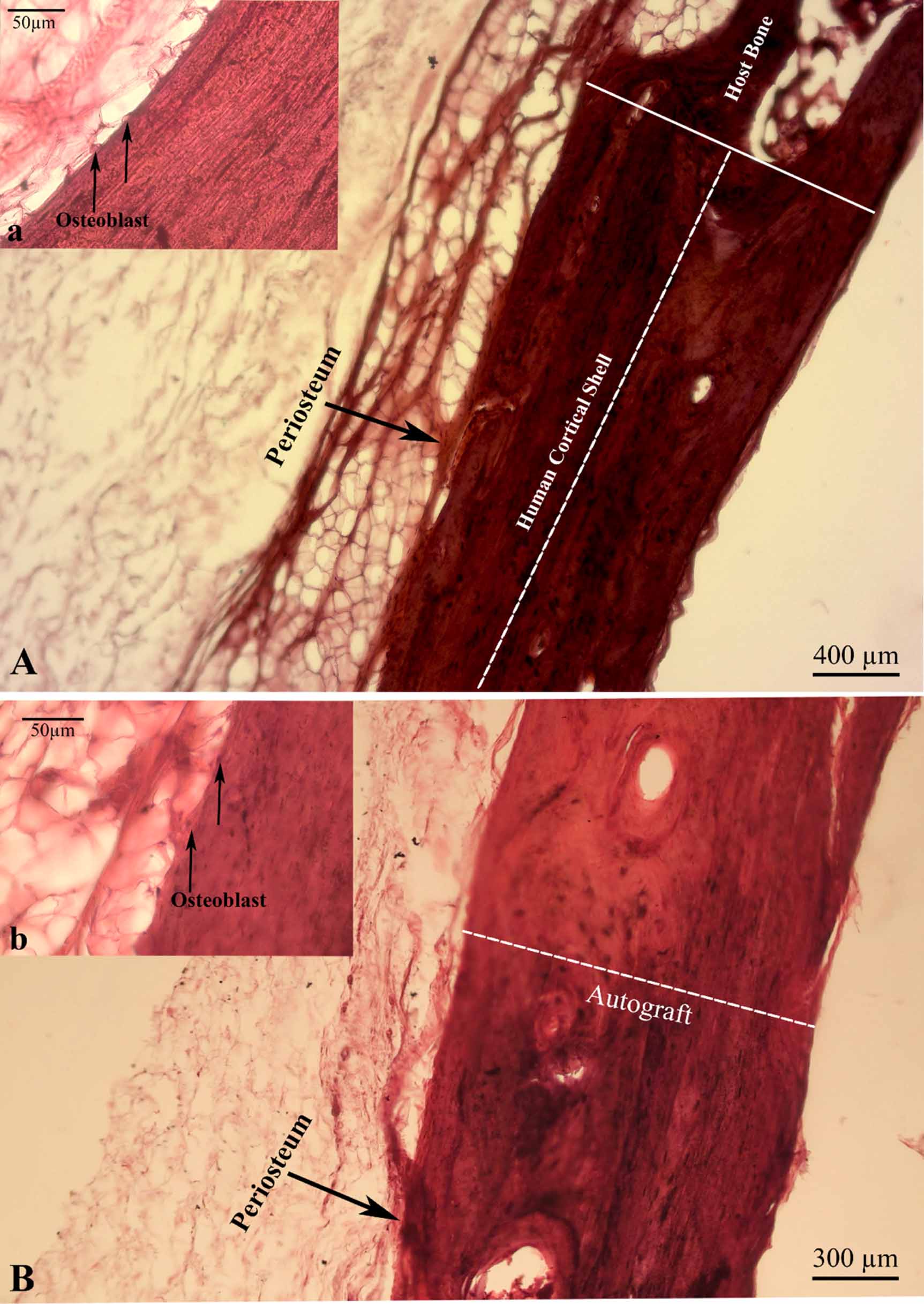 De Novo periosteum formation and remodeling activity in human cortical ...