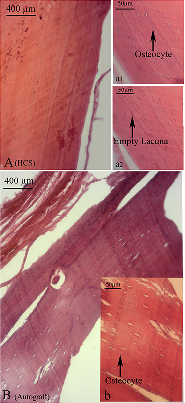 De Novo periosteum formation and remodeling activity in human cortical ...