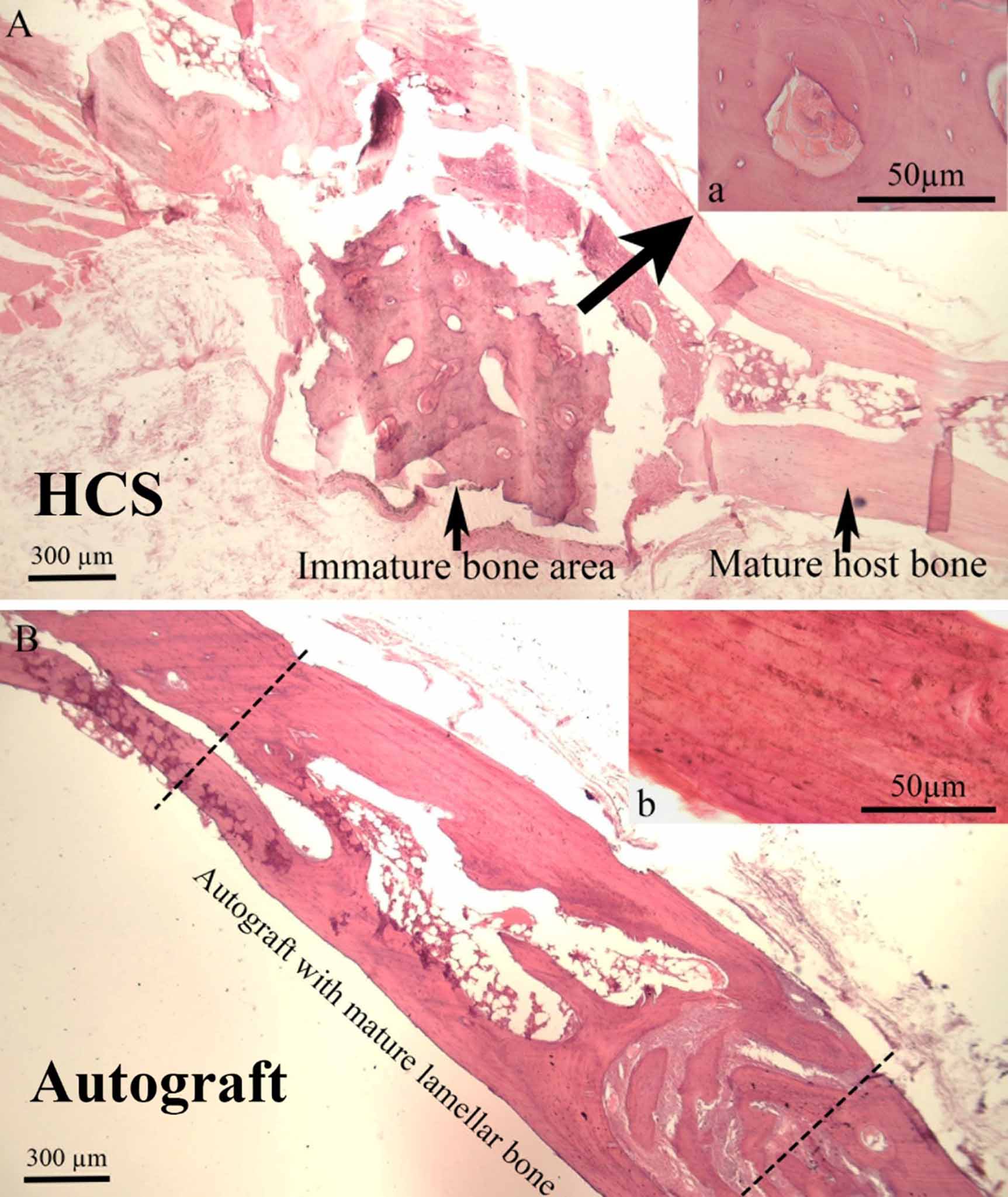 De Novo periosteum formation and remodeling activity in human cortical ...