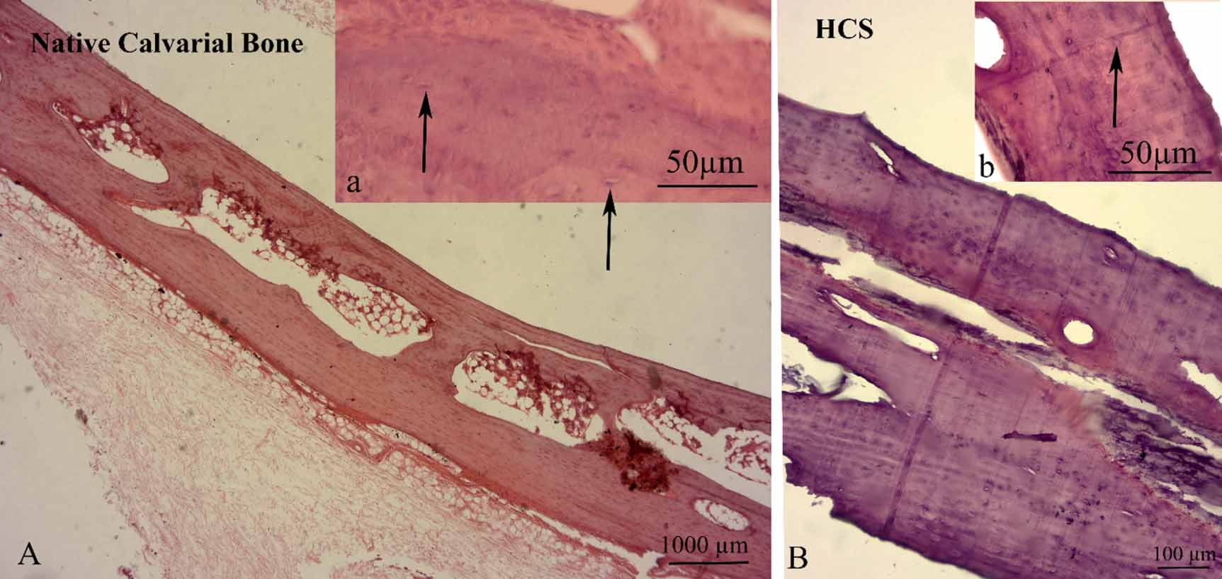 De Novo periosteum formation and remodeling activity in human cortical ...