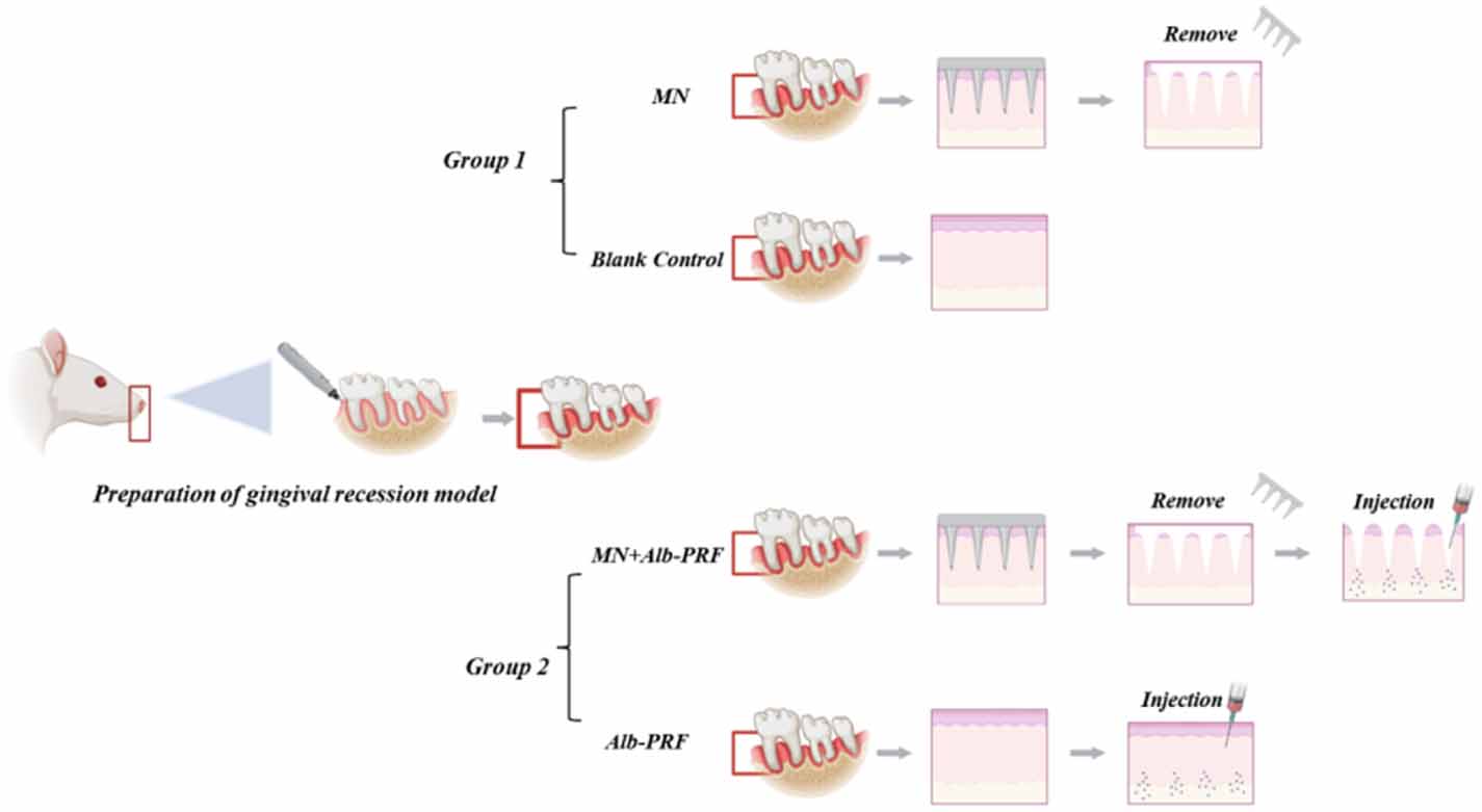 Microneedling (MN) combined with albumin gel and liquid platelet-rich ...