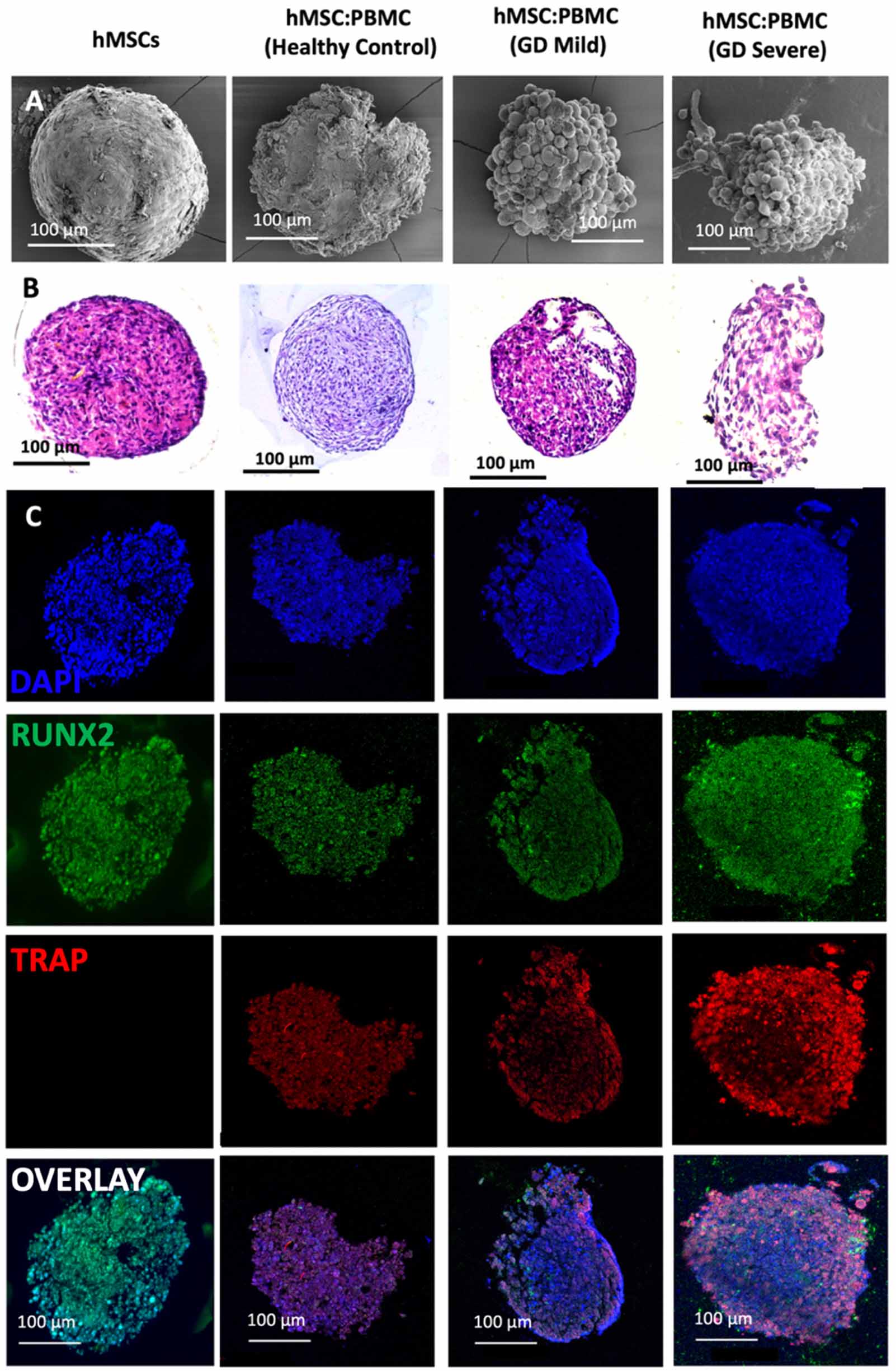 Biofabrication of an in-vitro bone model for Gaucher disease - IOPscience