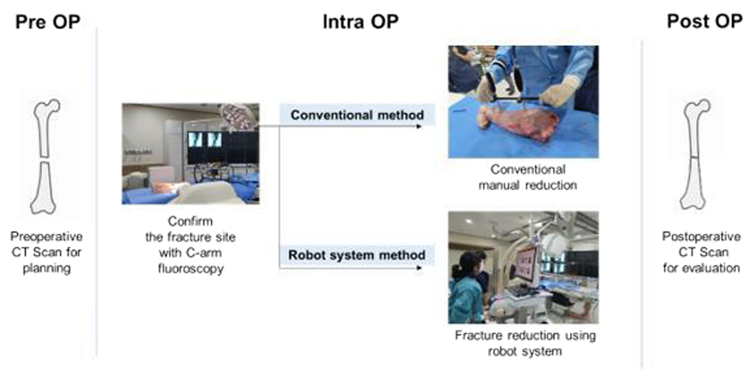 Clinical usability and efficacy of a robotic bone fracture reduction ...