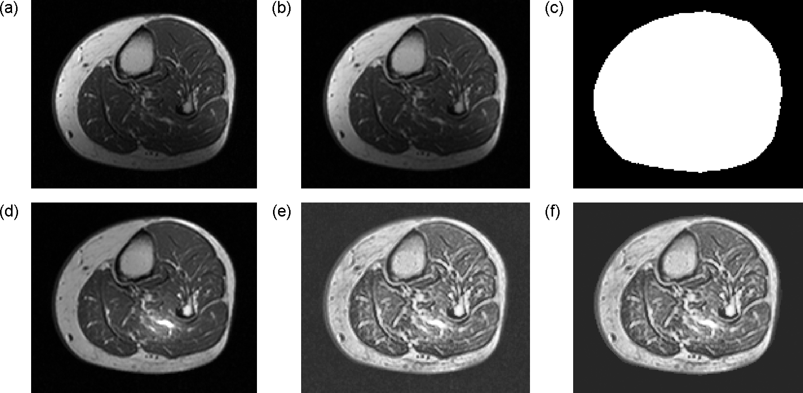 Mri Leg Performance Technique for the computation of lower leg muscle bulk from magnetic ...