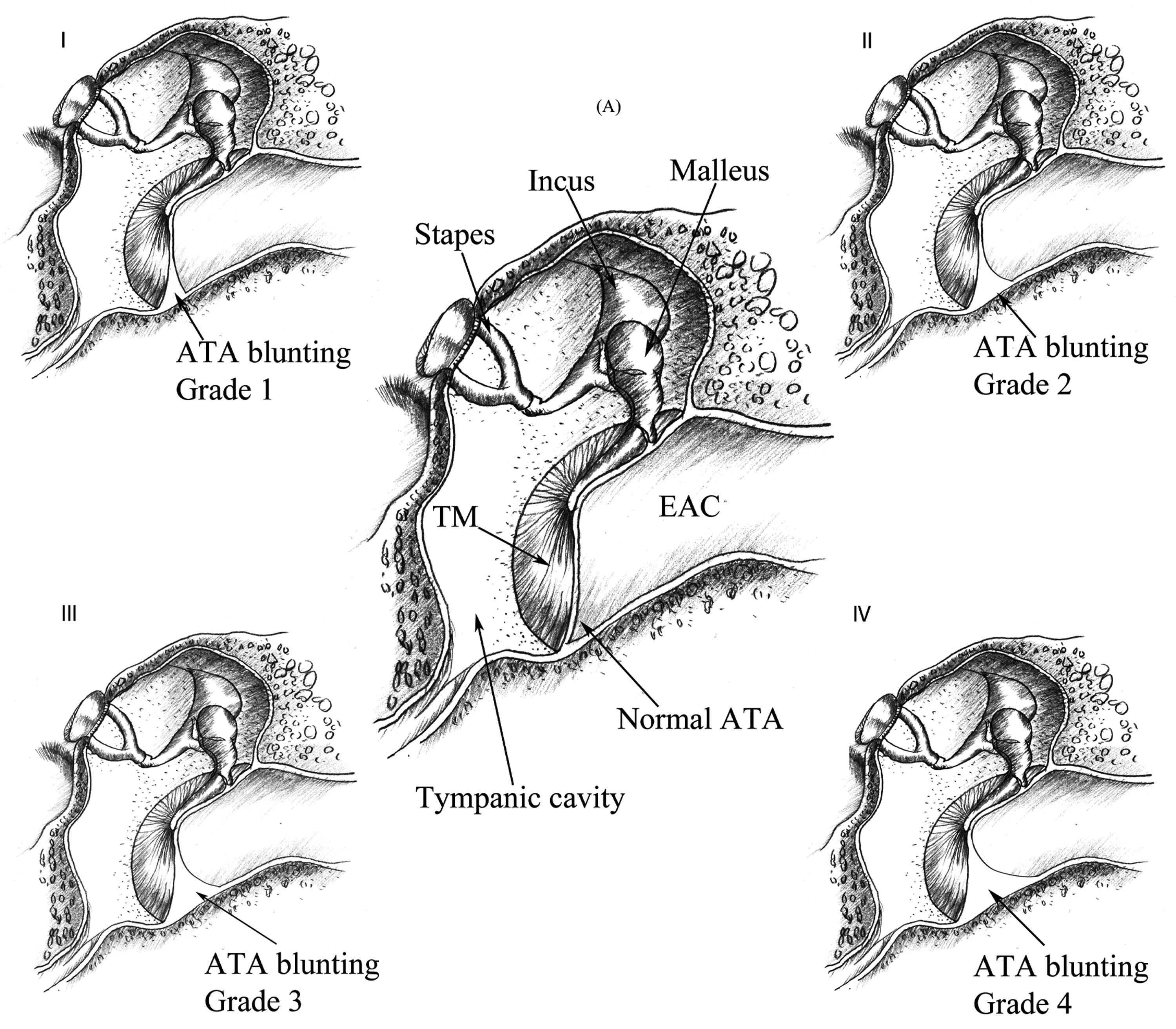 Effect of anterior tympanomeatal angle blunting on the middle ear ...