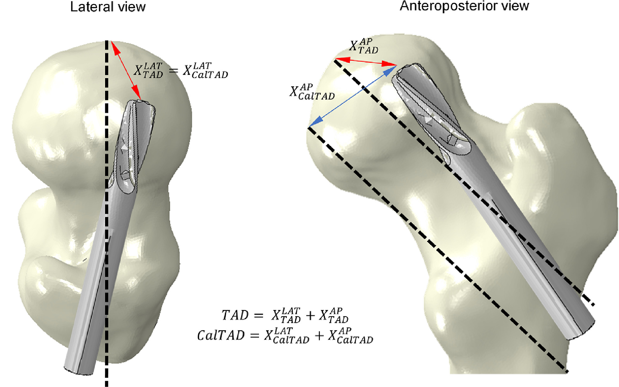 Influence of the PFNA screw position on the risk of cut-out in an ...