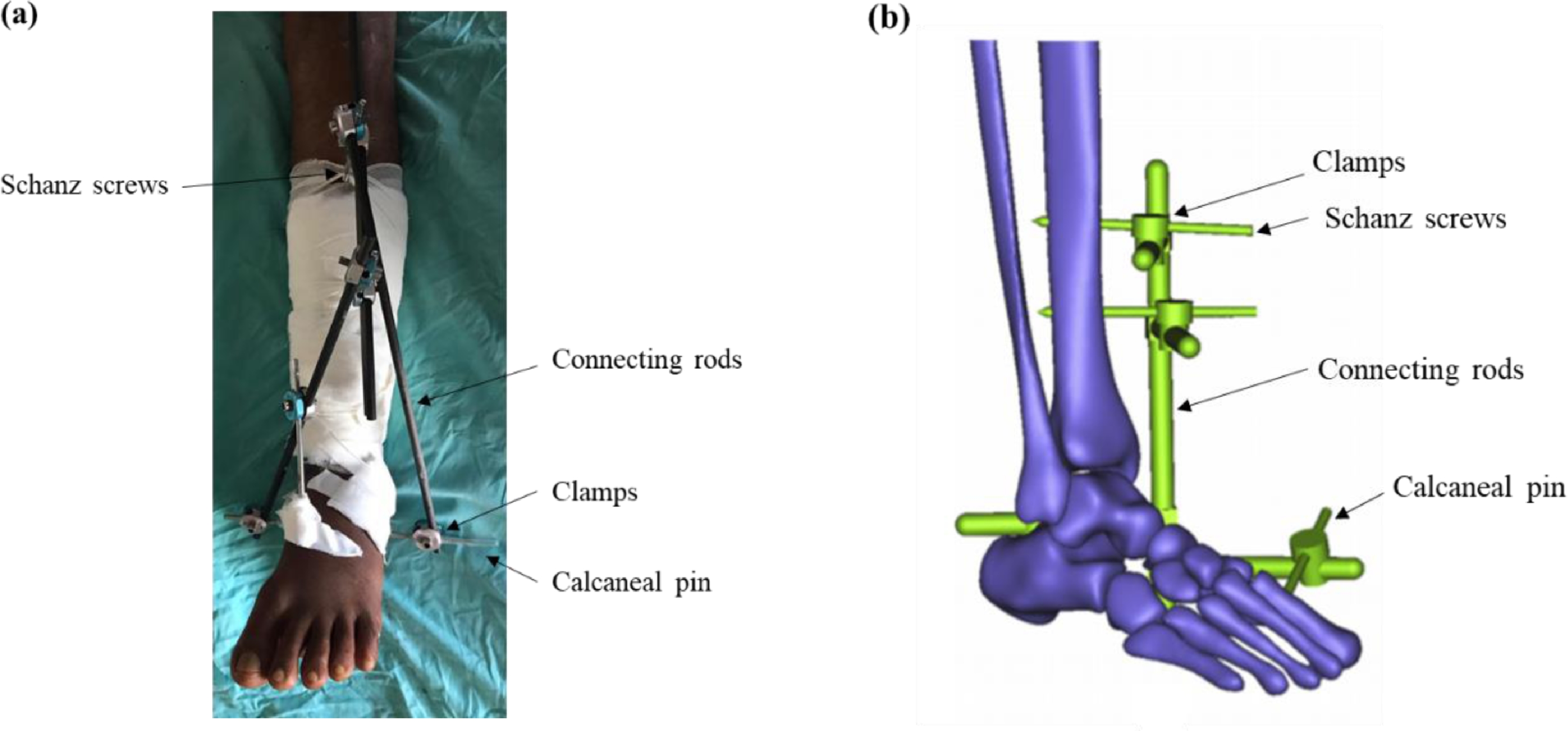An engineering review of external fixators - IOPscience