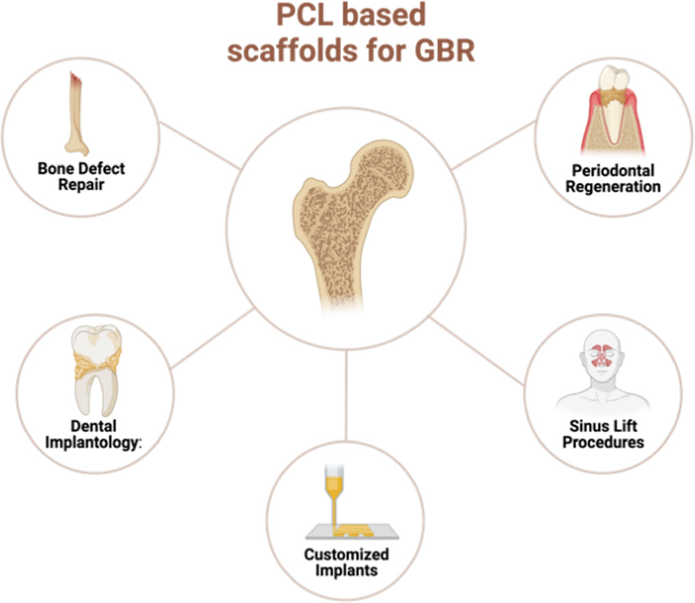 Advances in guided bone regeneration membranes: a comprehensive review ...
