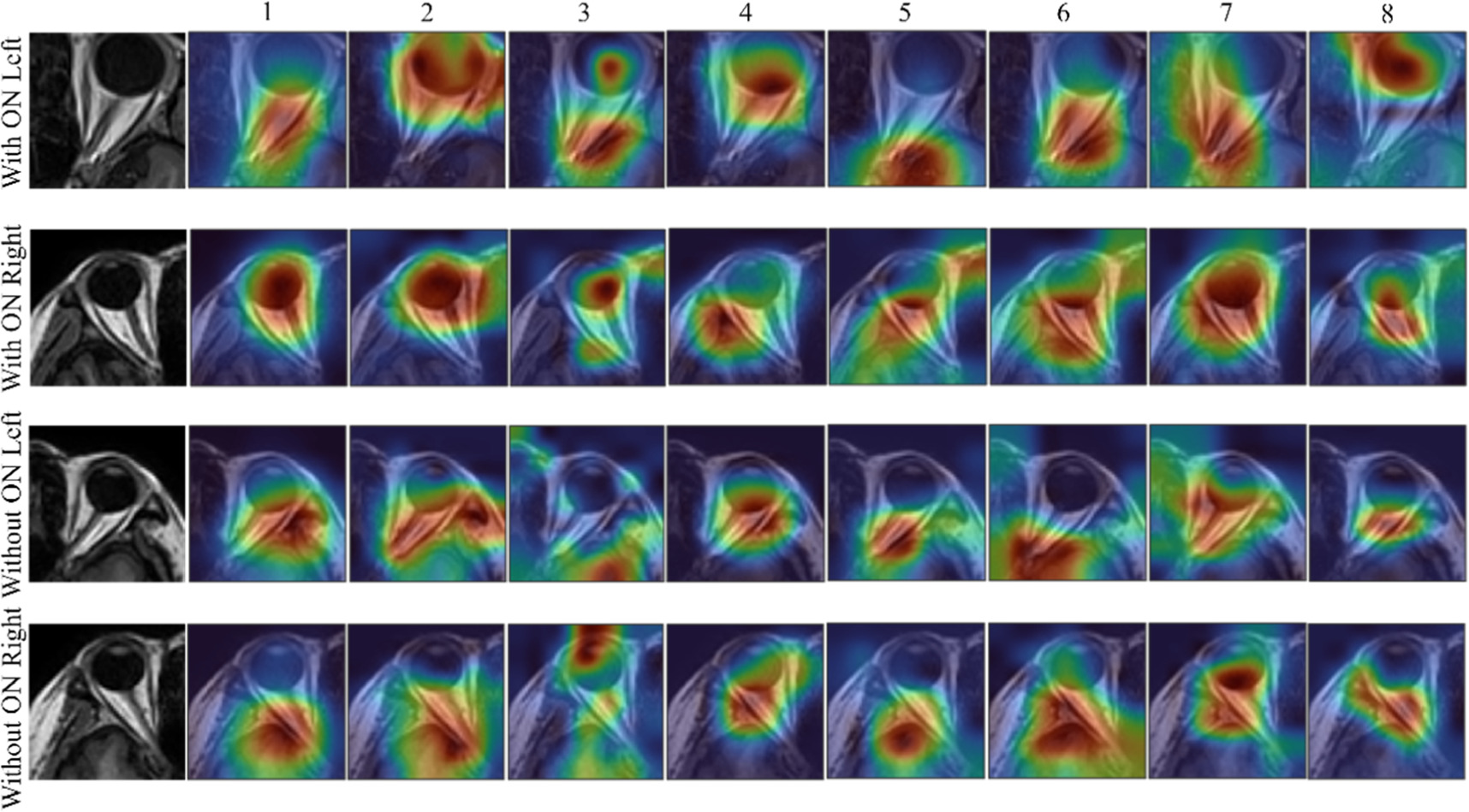 Classification of optic neuritis in neuromyelitis optica spectrum ...