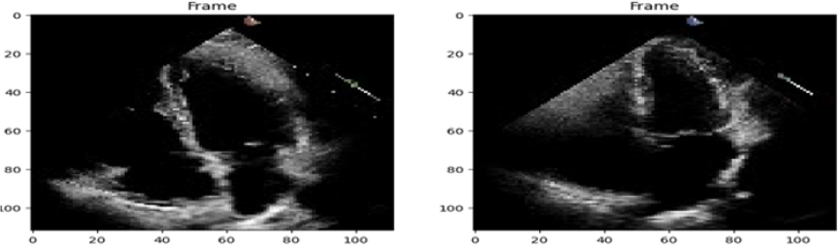 Automatic segmentation of echocardiographic images using a shifted ...