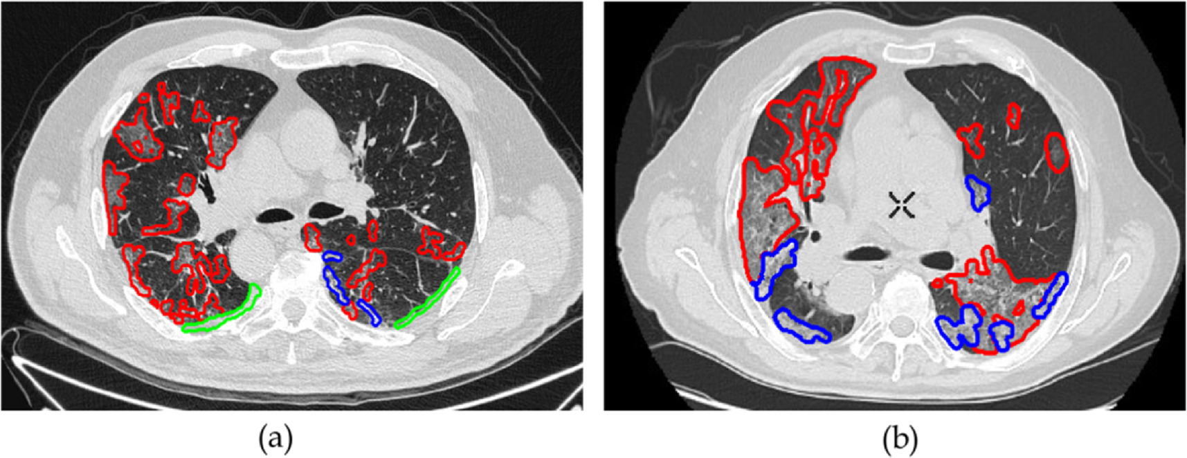 Radiomic features based automatic classification of CT lung findings ...