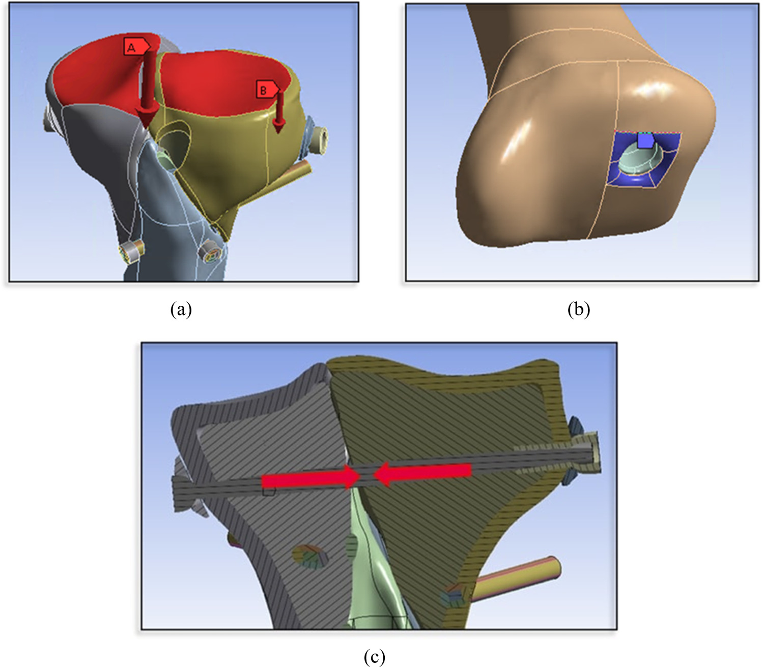 Comparative finite element analysis between three surgical techniques ...