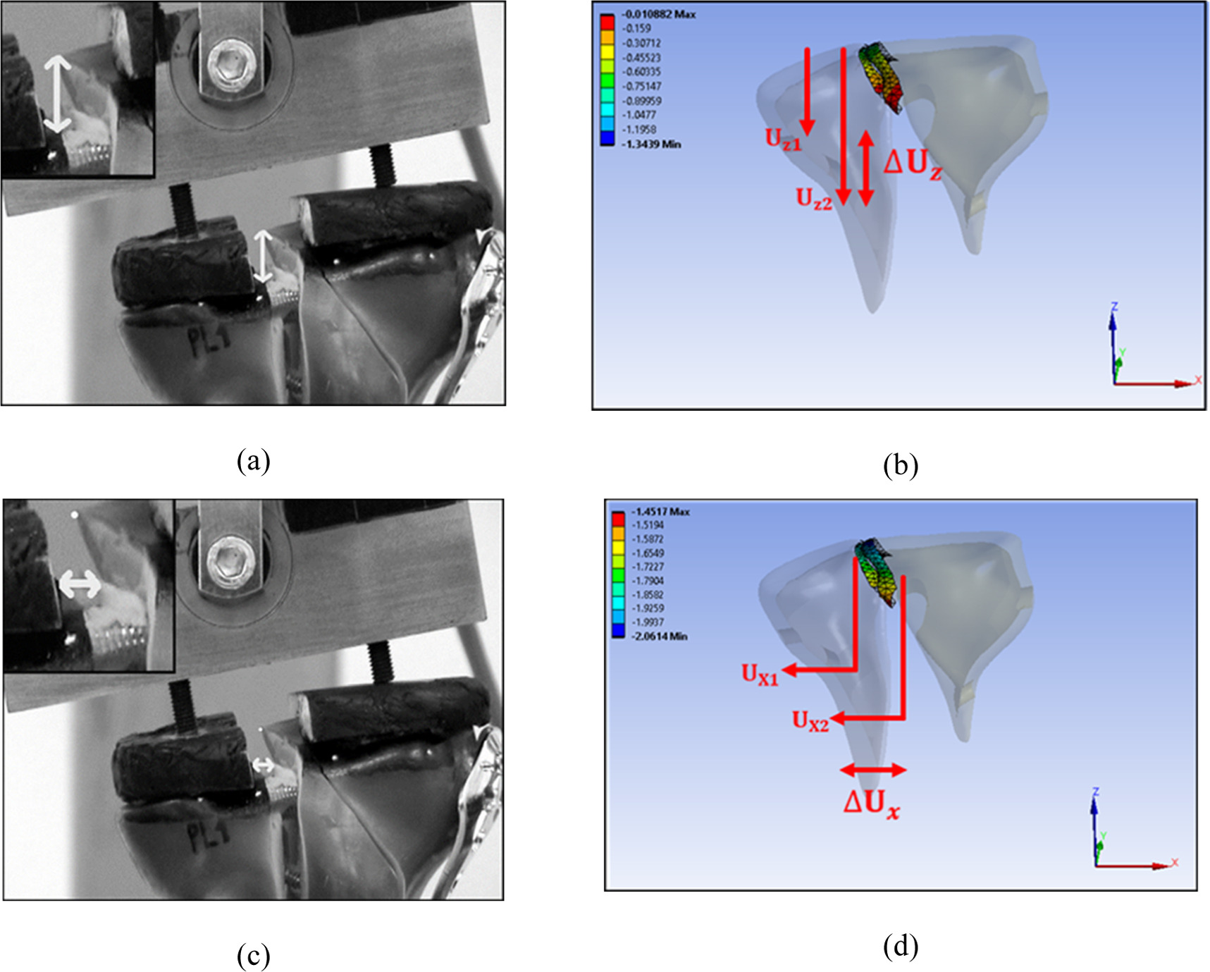 Comparative finite element analysis between three surgical techniques ...