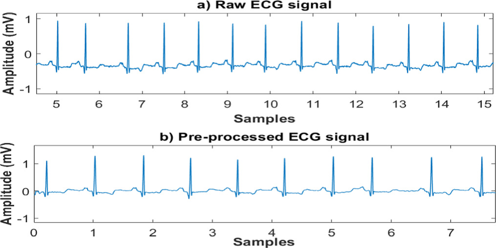 Automated classification of cardiac arrhythmia using short-duration ECG ...