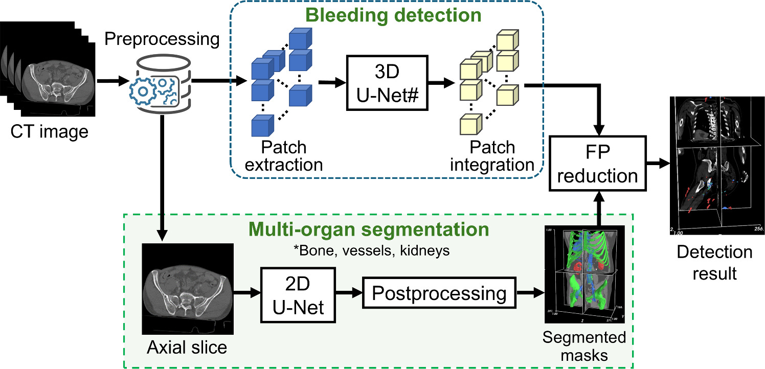 Automated detection of traumatic bleeding in CT images using 3D U-Net ...