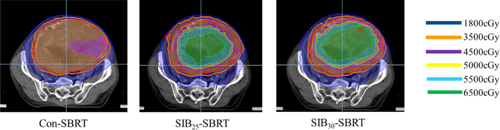 Tp Shell Radiotherapy Feasibility study of synchronously increasing dose of multi-shell ...