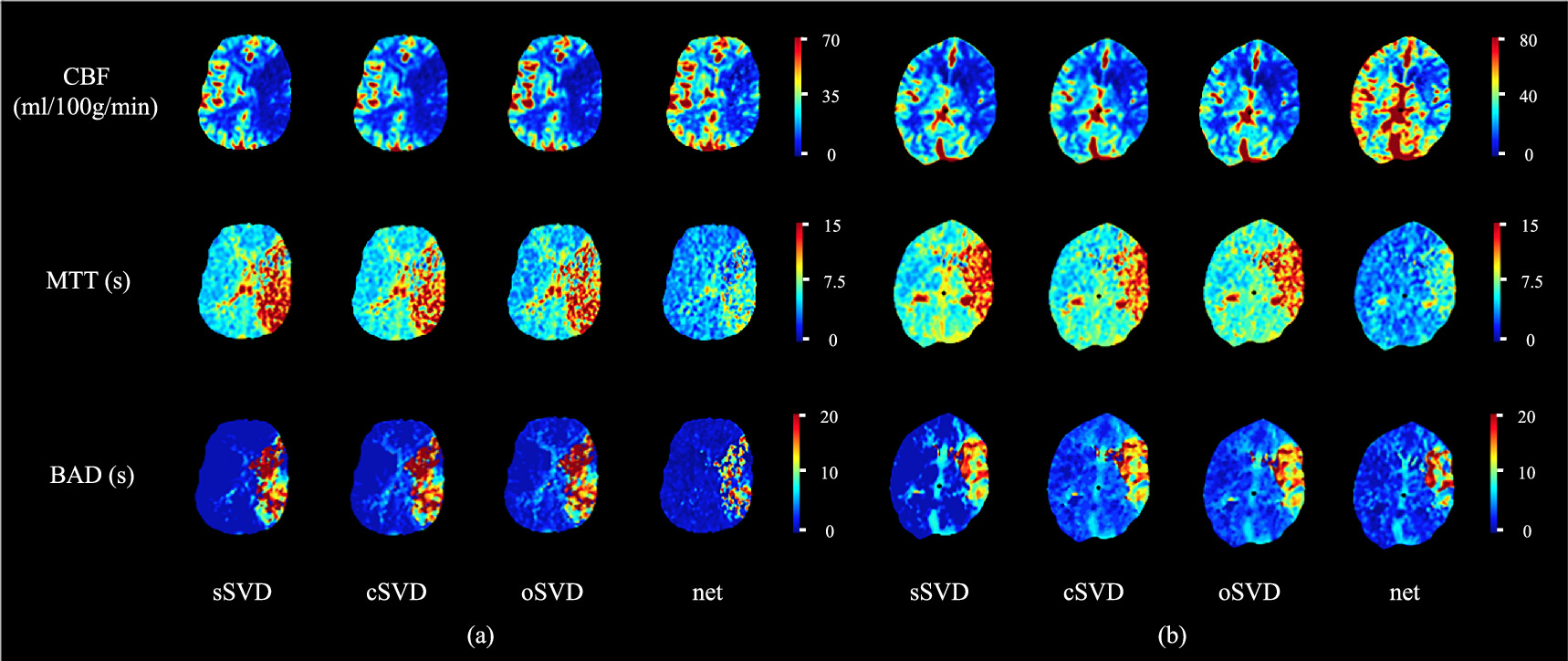 A deep learning approach for quantifying CT perfusion parameters in ...