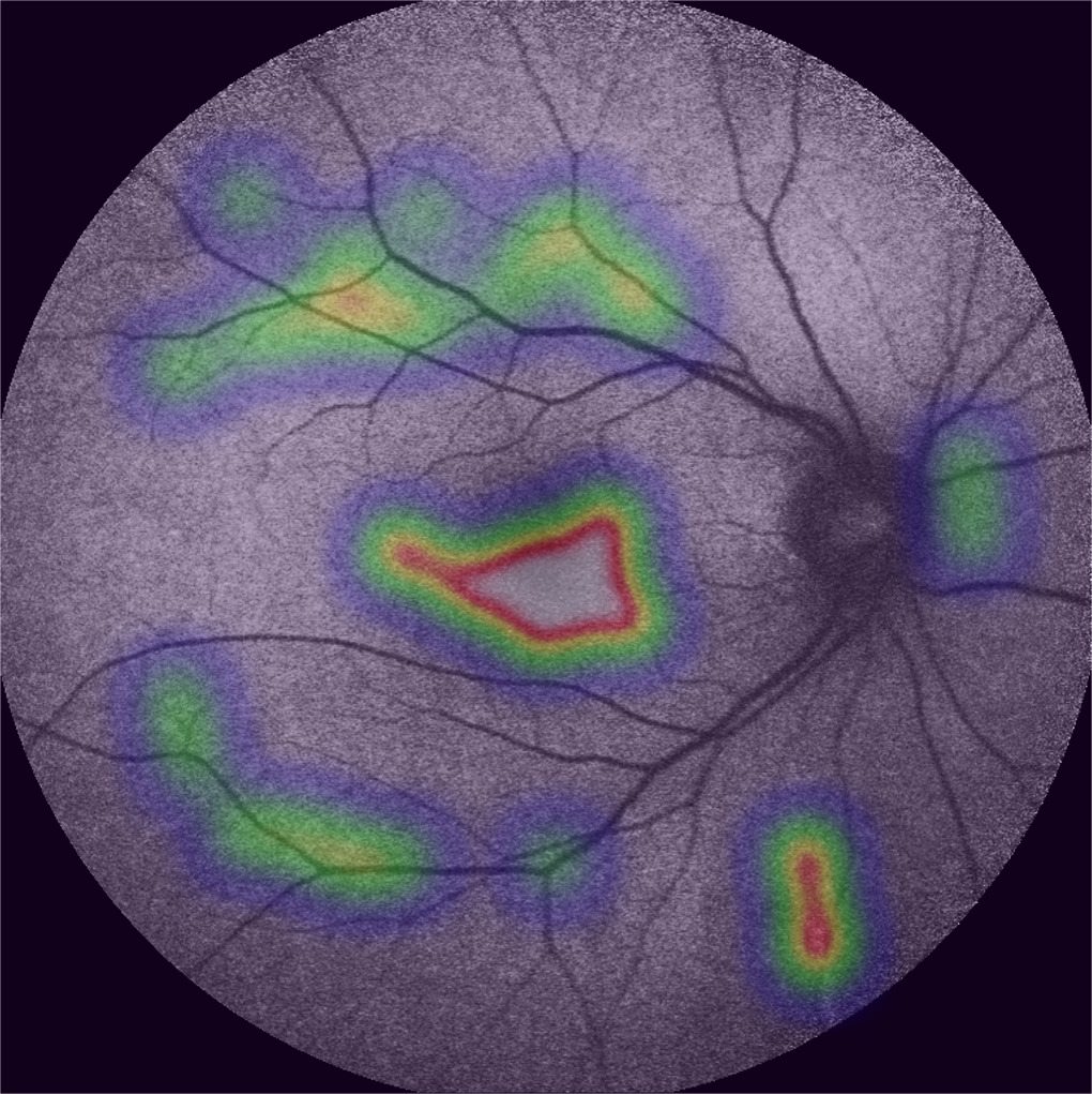 Artificial intelligence techniques in inherited retinal diseases: a ...