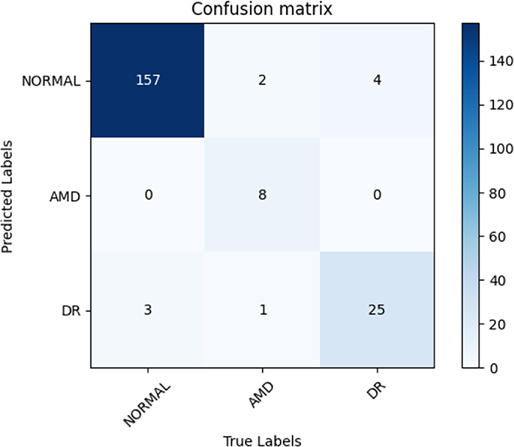 Multi-modal classification of retinal disease based on convolutional ...