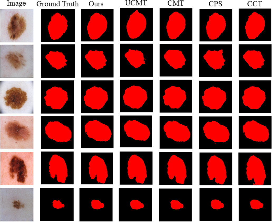 Semi-supervised medical image segmentation based on multi-stage ...