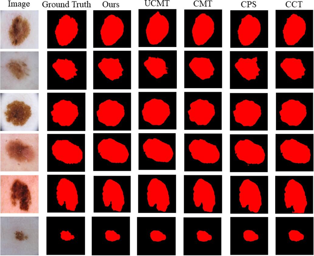 Semi-supervised medical image segmentation based on multi-stage ...