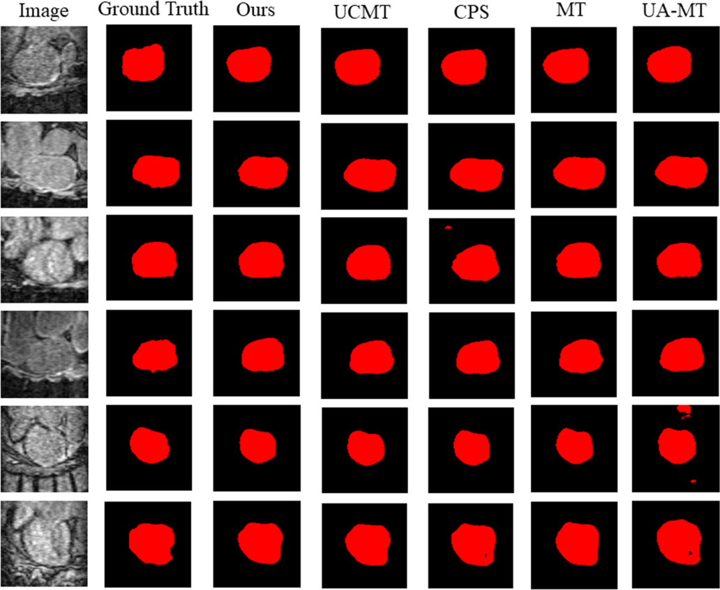 Semi-supervised medical image segmentation based on multi-stage ...