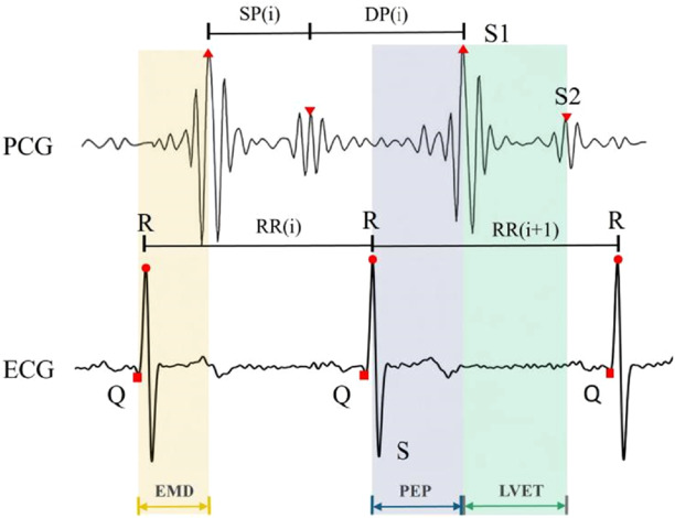 Machine learning-based CAD detection using integrated ECG and PCG ...