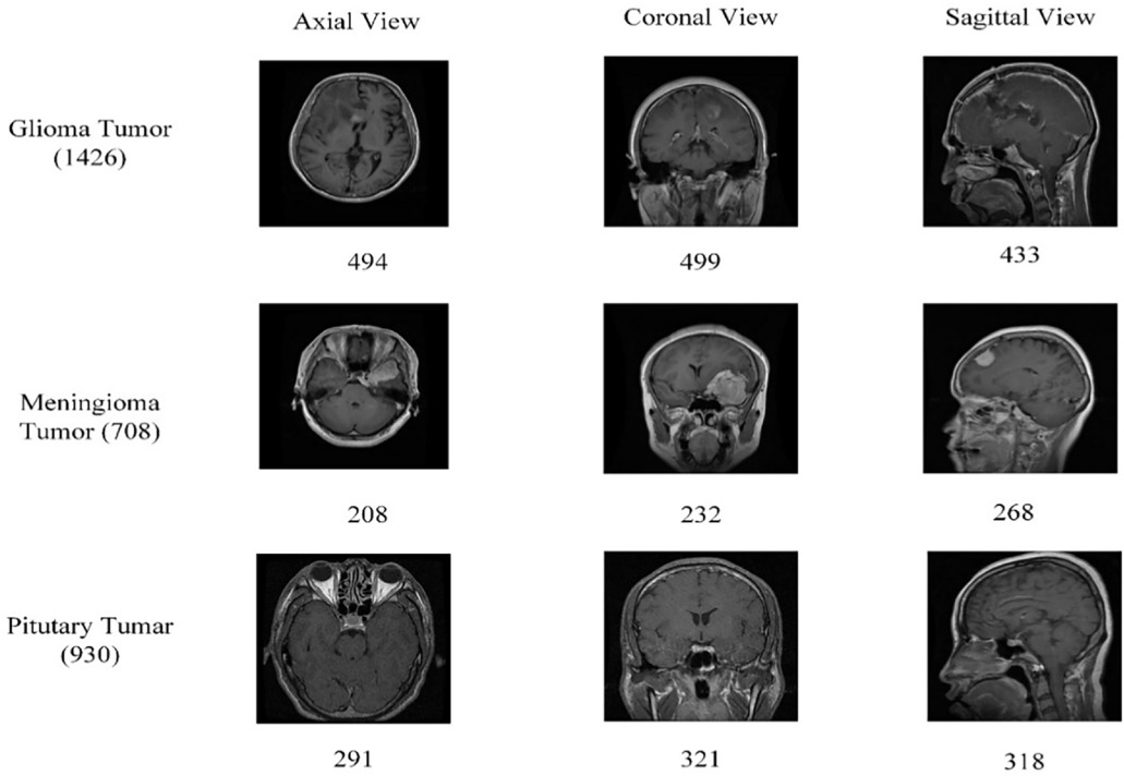 A hybrid model for brain tumor classification via deep feature ...