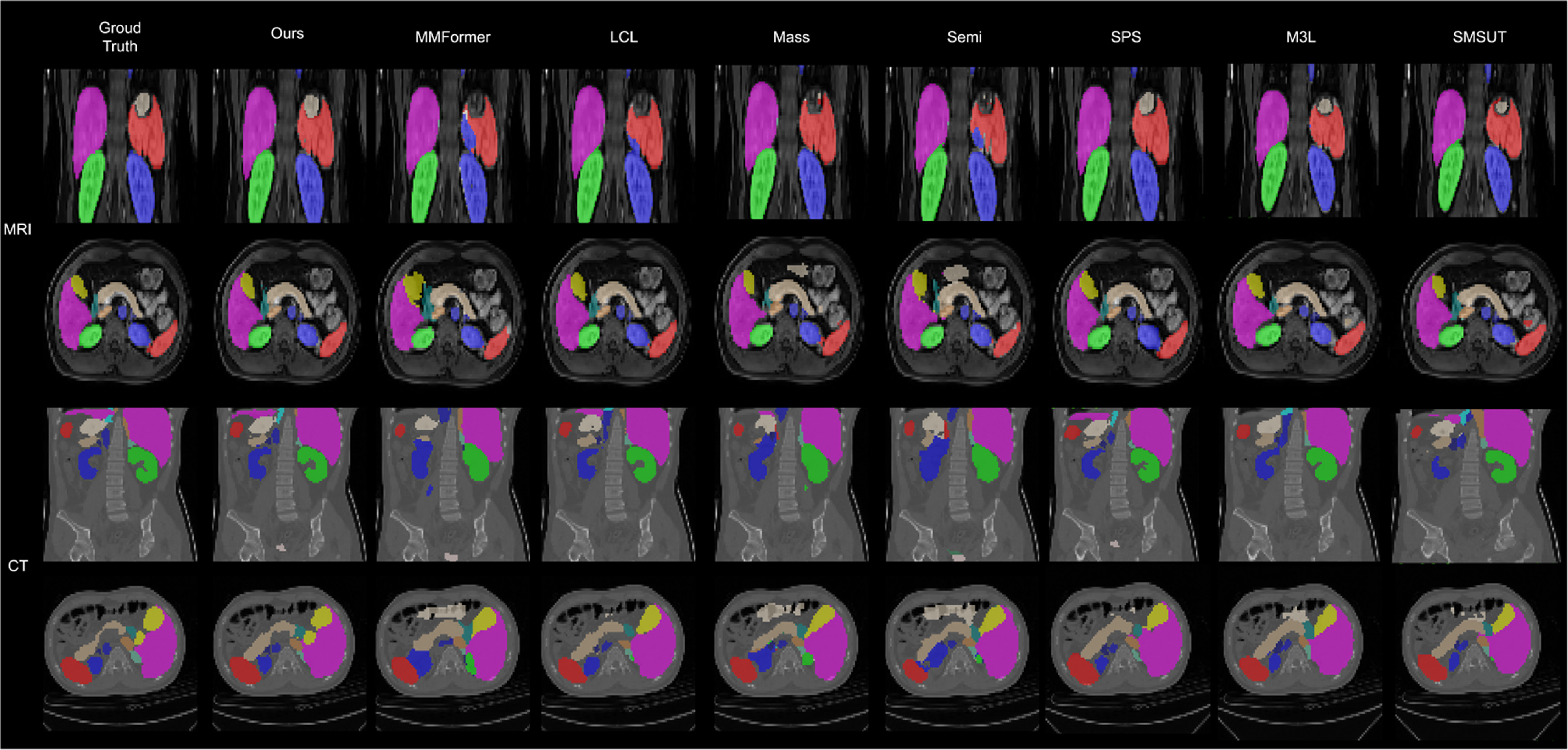 Multi-modal semi-supervised medical image segmentation via spatial ...