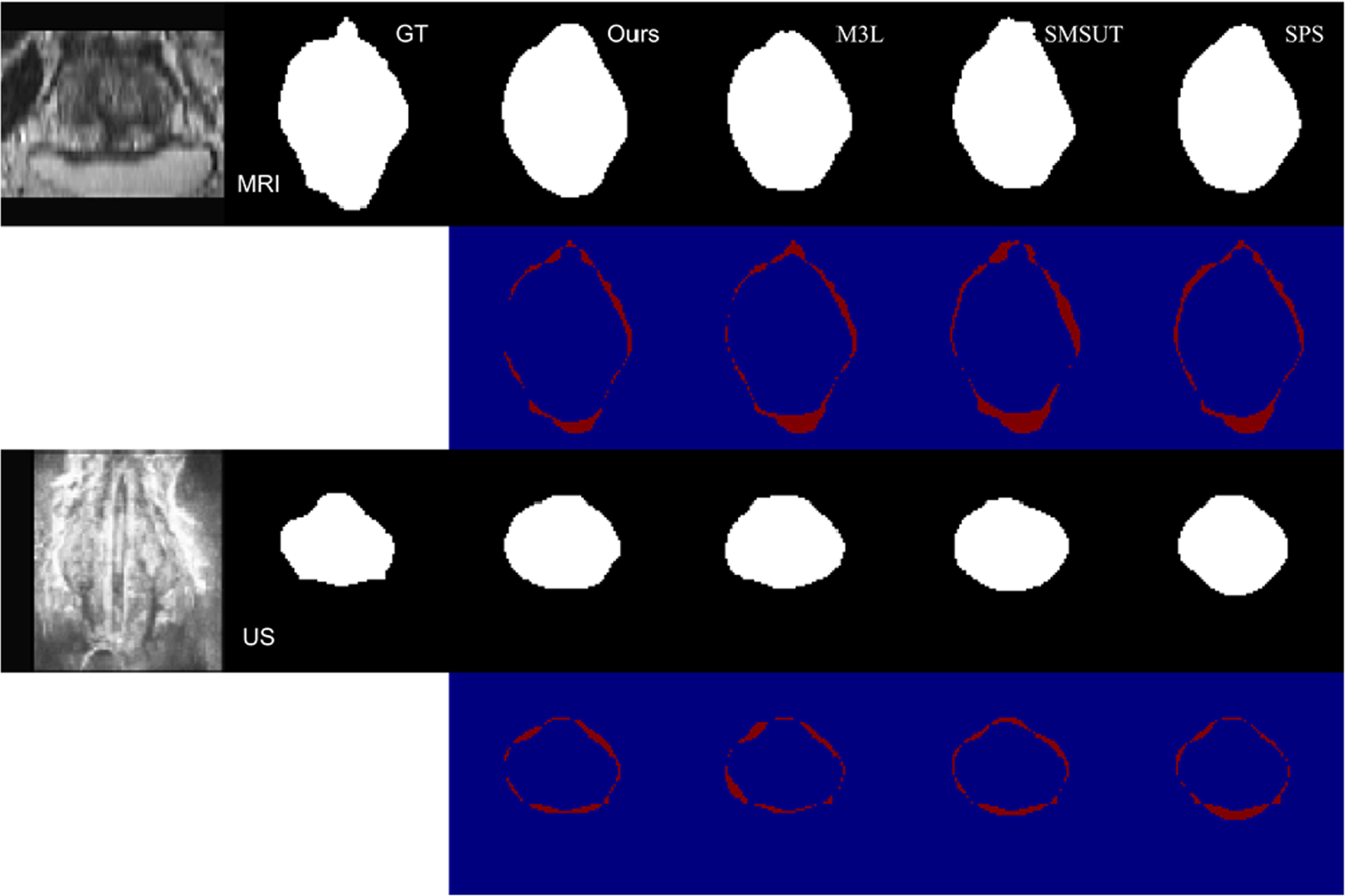 Multi-modal semi-supervised medical image segmentation via spatial ...