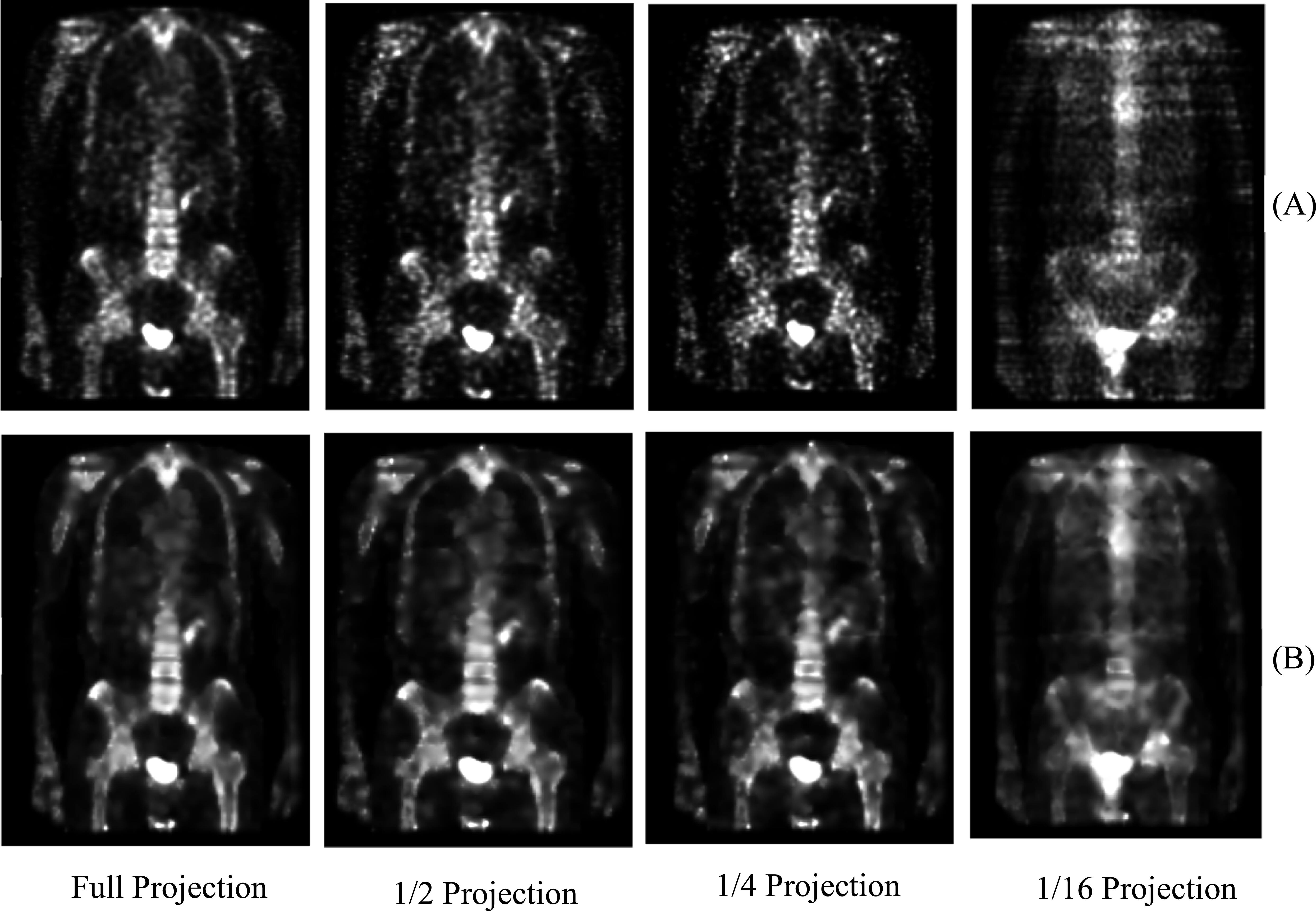Anatomically CT-guided iterative reconstruction using KEM for sparse ...