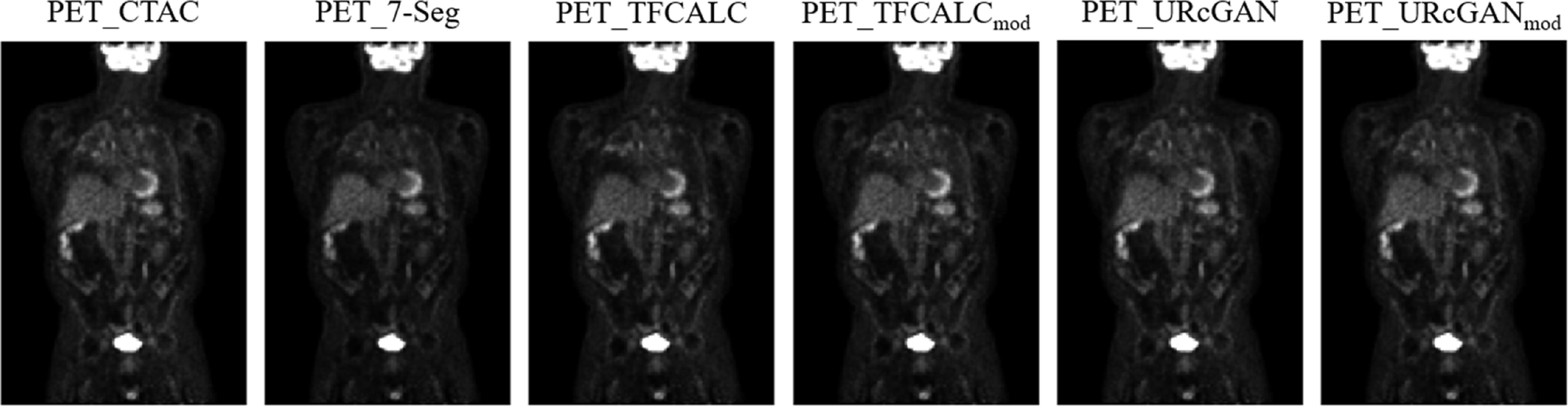 Torso synthetic CT generation by integrating deep learning and ...