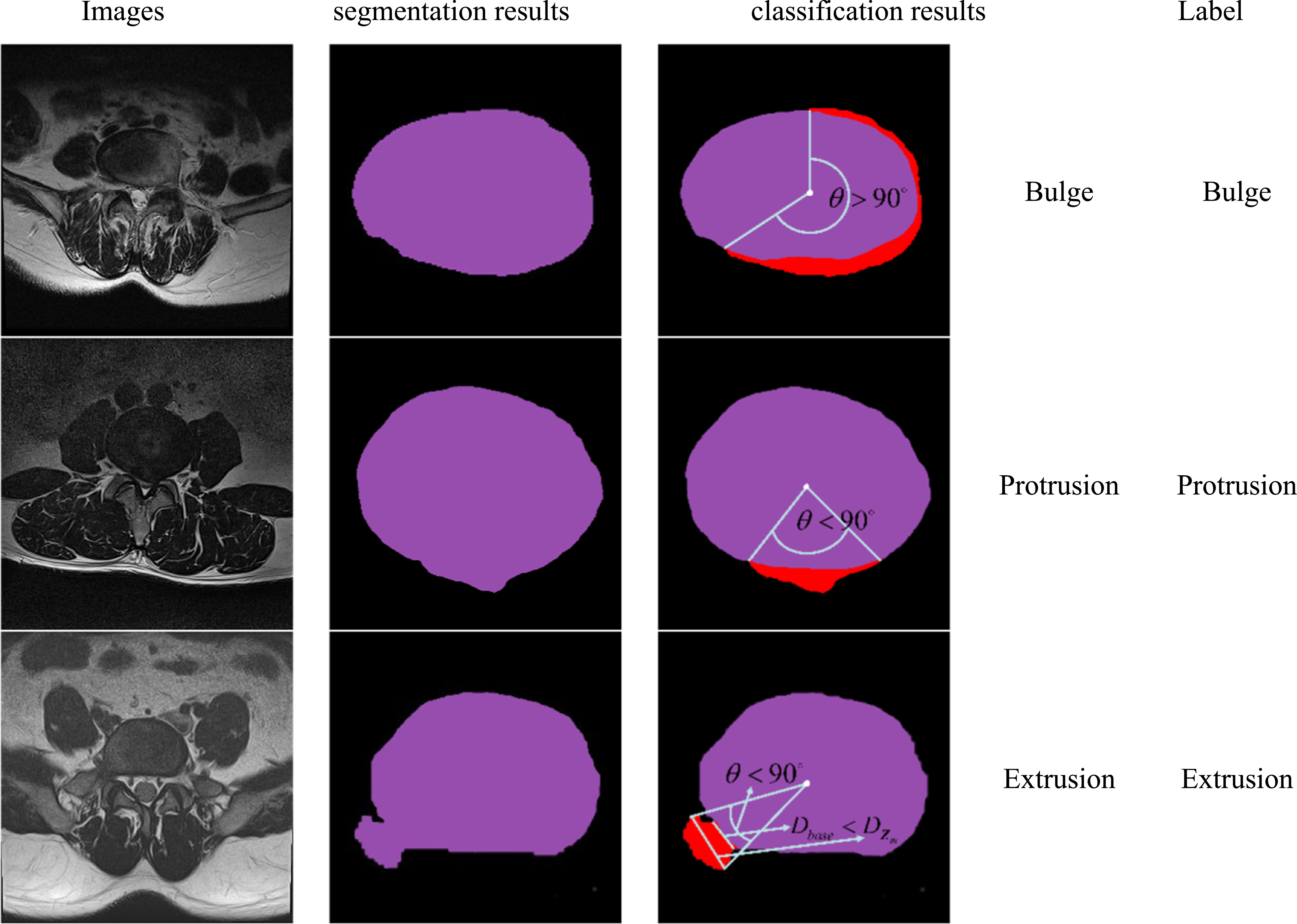 Enhancing lumbar disc herniation classification through region-of ...