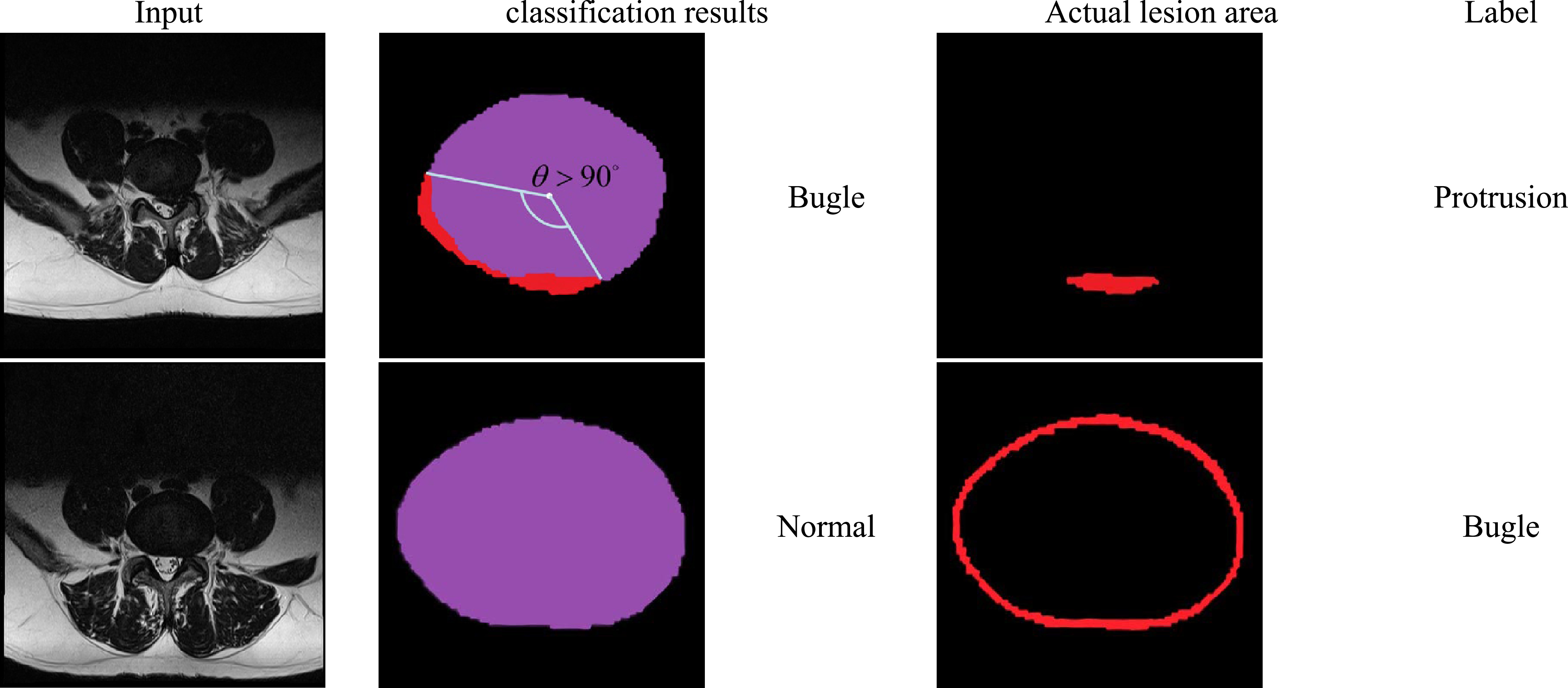 Enhancing lumbar disc herniation classification through region-of ...