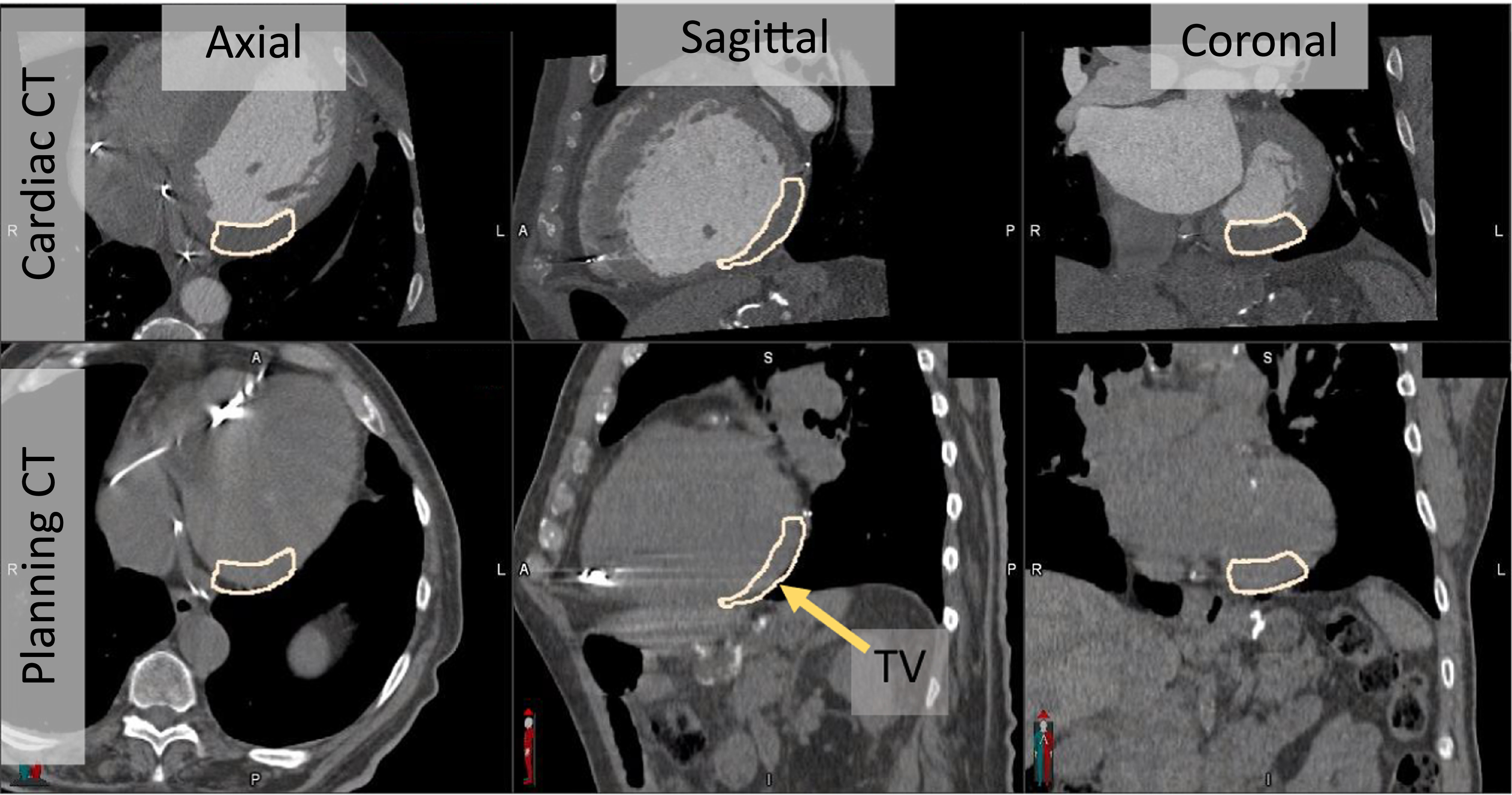 Star Resolution Pattern Radiology Interobserver image registration variability impacts on stereotactic ...