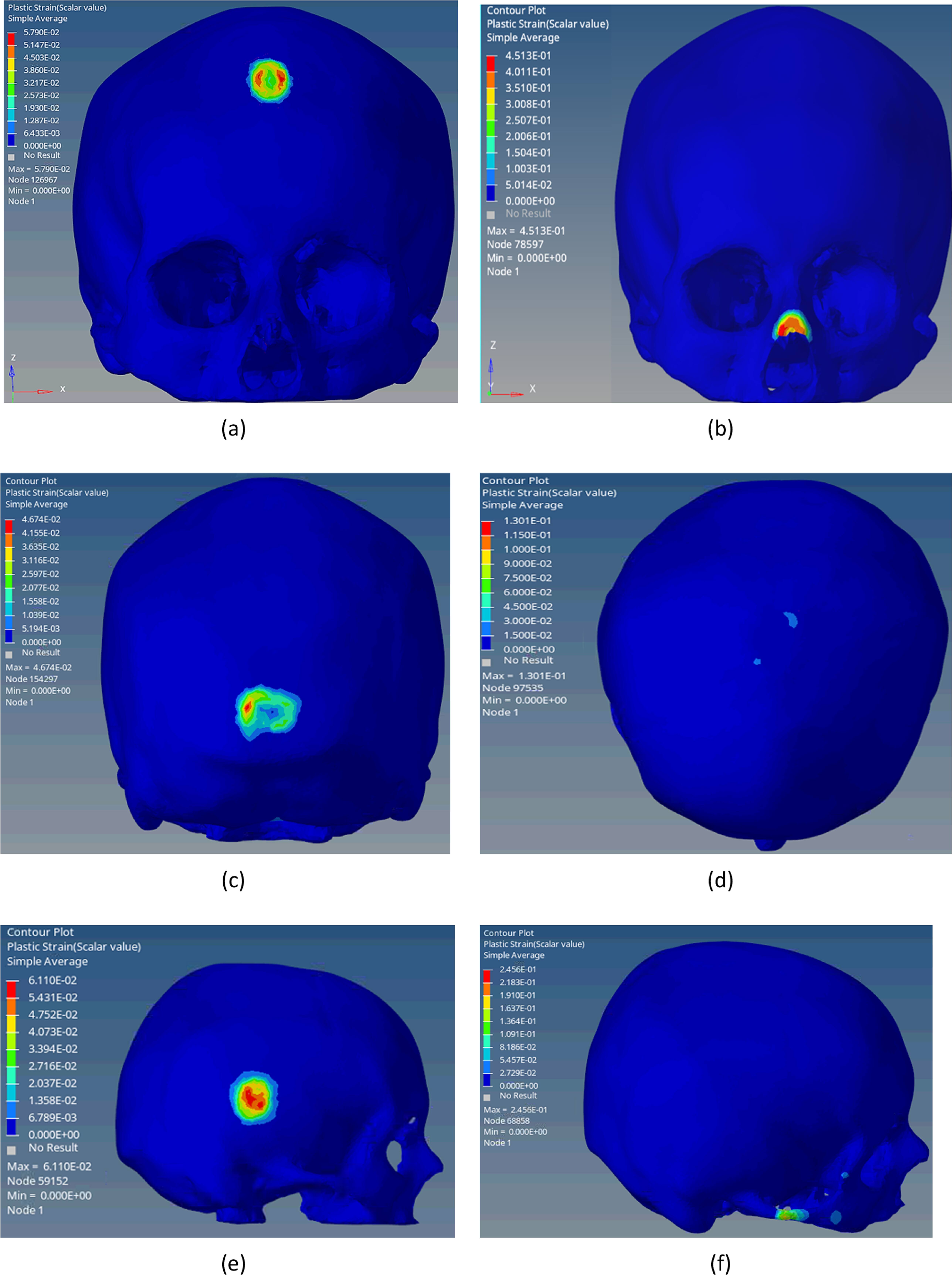 Biomechanical response of human skull to impact by three-dimensional ...